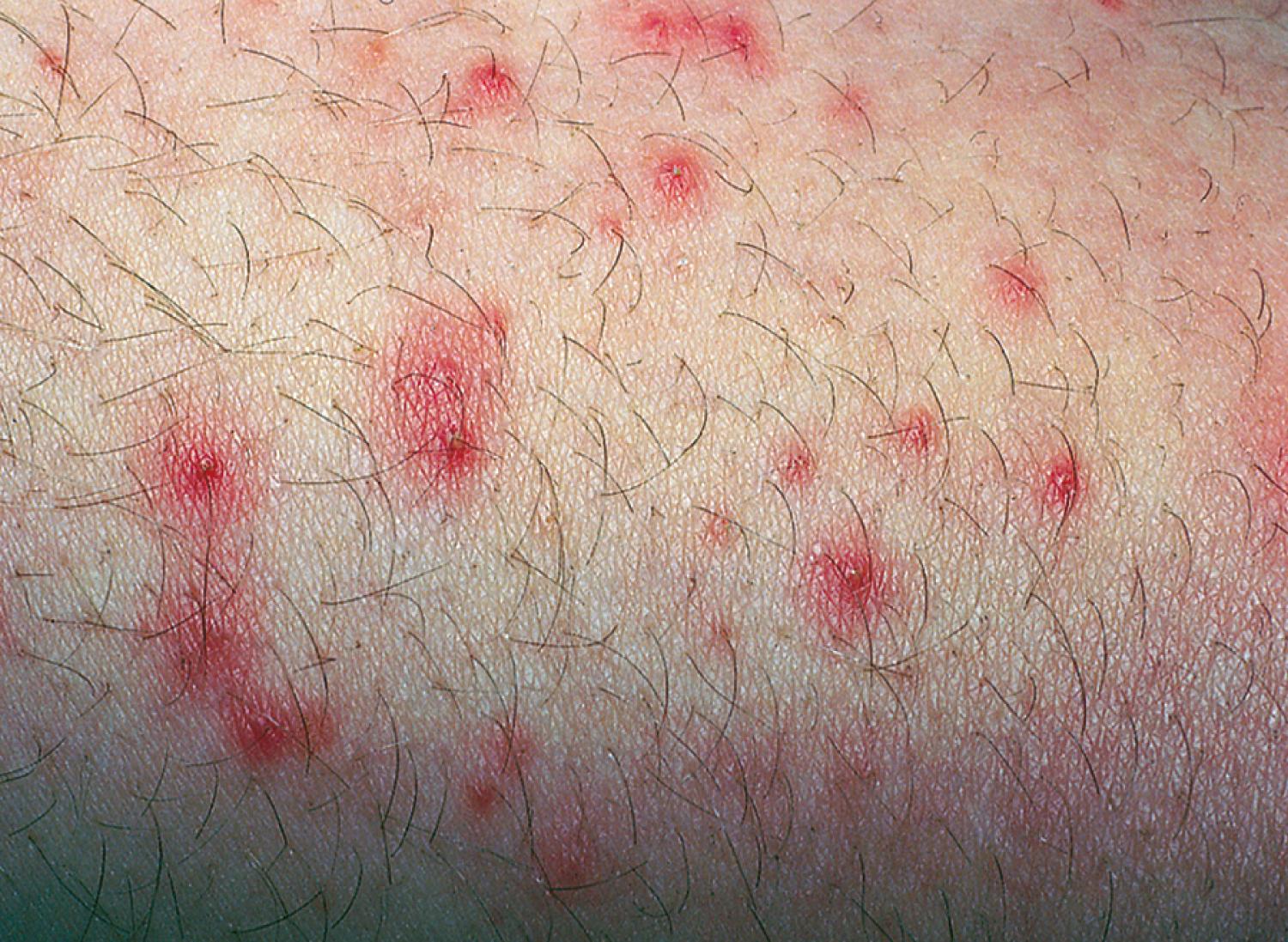 Fig. 13.21, Folliculitis. The extensor surfaces of the extremities and other hair-bearing areas are the most common sites of this superficial infection of hair follicles. Lesions begin at the base of a hair shaft as erythematous nodules and then evolve to form central pustules with a thin, red rim.