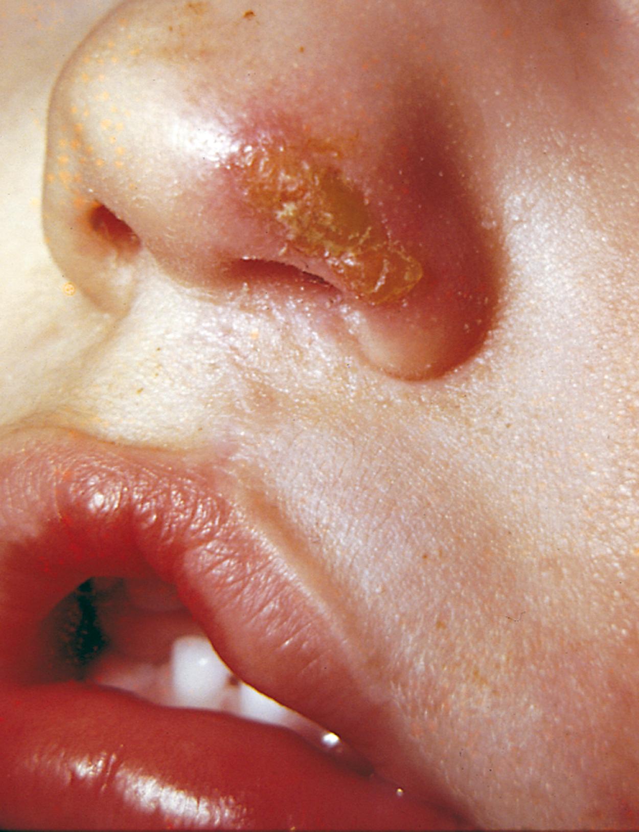 Fig. 13.22, Streptococcal impetigo. This impetiginous lesion has evolved from a papule to a vesicle that ruptured, producing the characteristic honey-colored crust.