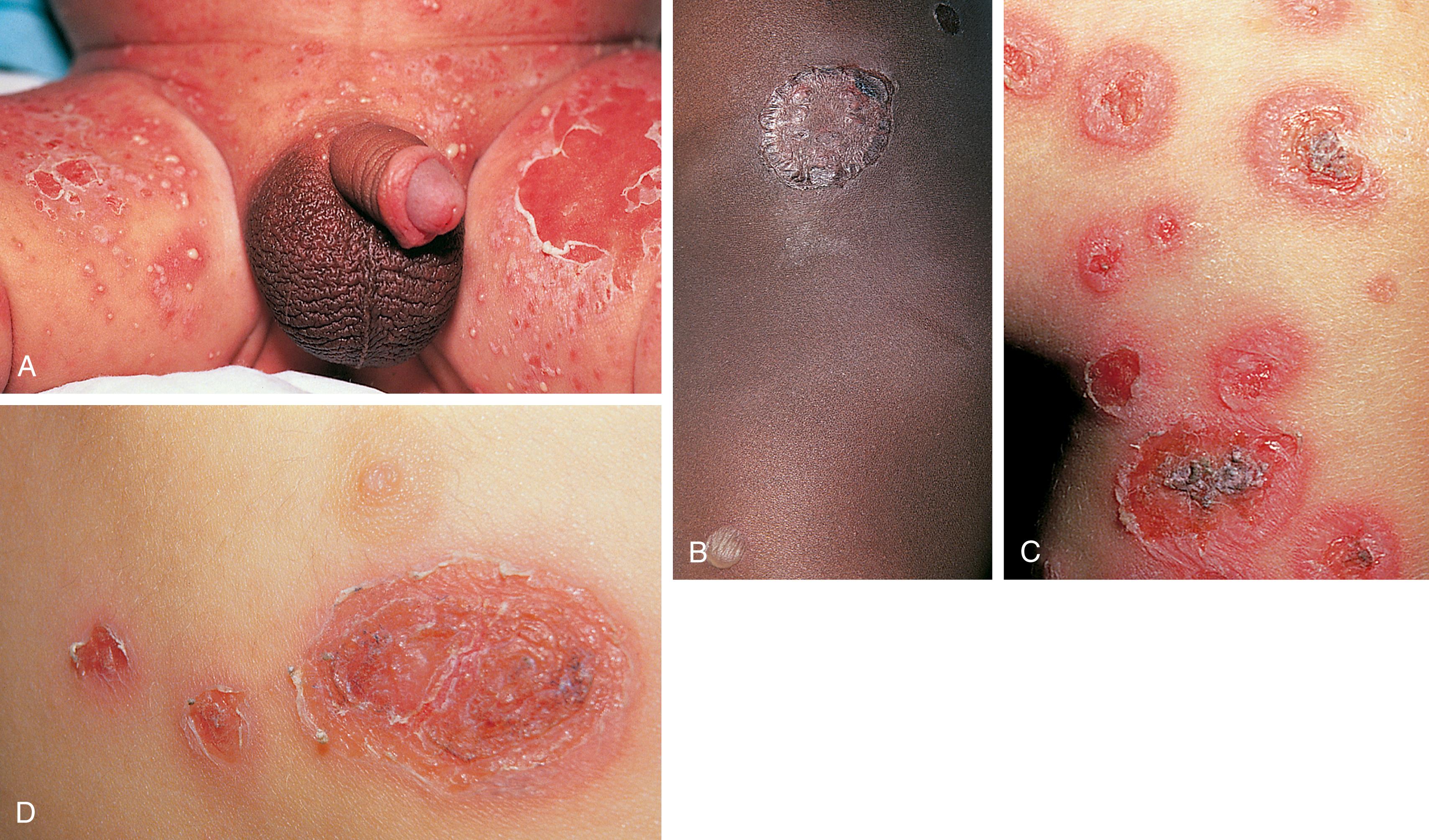 Fig. 13.23, Staphylococcal impetigo. (A) This infant with staphylococcal diaper dermatitis has multiple small, thin-walled pustules that rupture rapidly and coalesce, leaving a shallow base and a superficial peeling rim. (B) The various stages of bullous impetigo are evident in this child. Inferiorly an unruptured flaccid bulla is seen with an older lesion above it that has spread outward and crusted peripherally; just above that, another bulla has just ruptured. (C) In this child with staphylococcal impetigo, older lesions have central crusts with bullous rims that are spreading outward. (D) The features of long-standing impetigo are seen in this youngster whose lesions are crusted in rings, resembling an onion slice. Also note the smaller satellites surrounding the larger primary lesion.