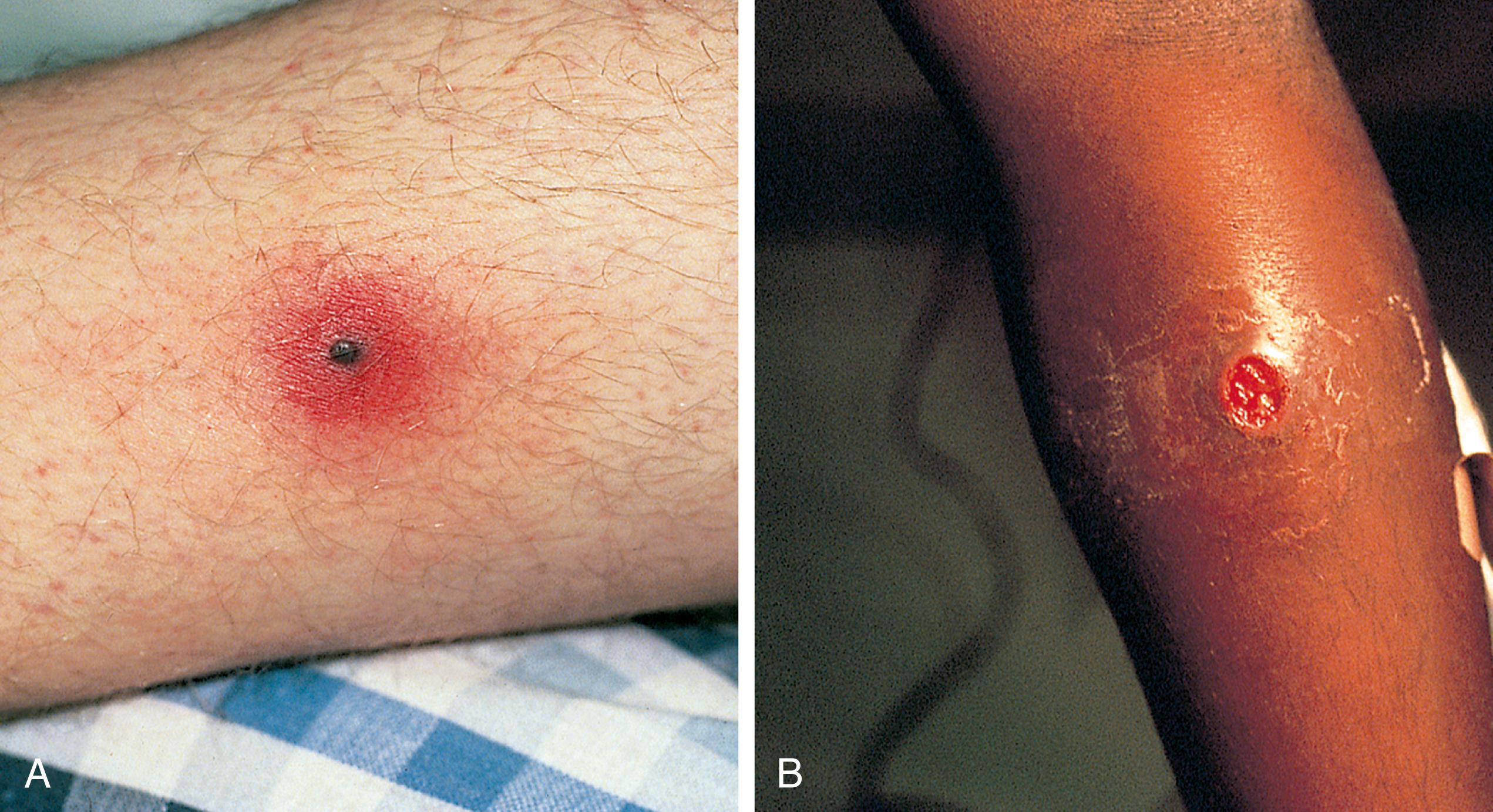 Fig. 13.24, Ecthyma. (A) In focal ecthyma resulting from the inoculation of group A streptococci, the lesion initially consists of a central vesicle or pustule (that rapidly crusts over) on a painful, indurated, erythematous base. (B) With progression a deep, widening ulcer forms, as seen in this child after removal of the overlying crust.