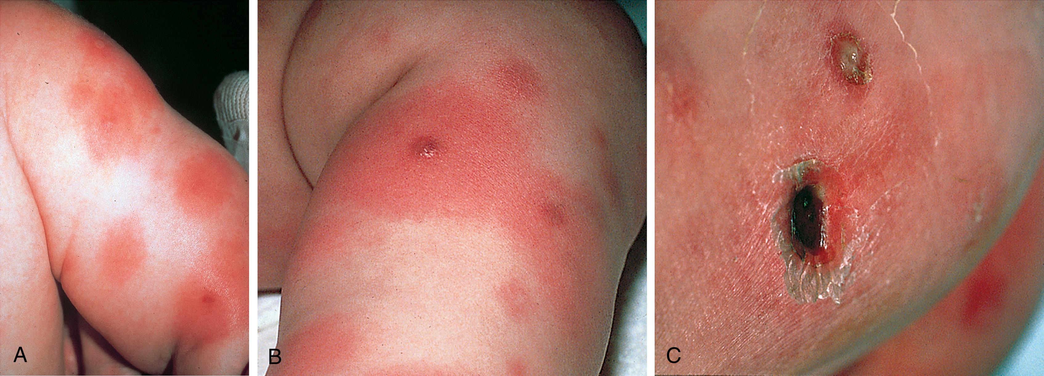 Fig. 13.25, Ecthyma gangrenosum. Pseudomonas septicemia may result in metastatic ecthymatous lesions that begin as pink macules (A), become hemorrhagic (B), and ultimately necrose centrally to form a black eschar (C).