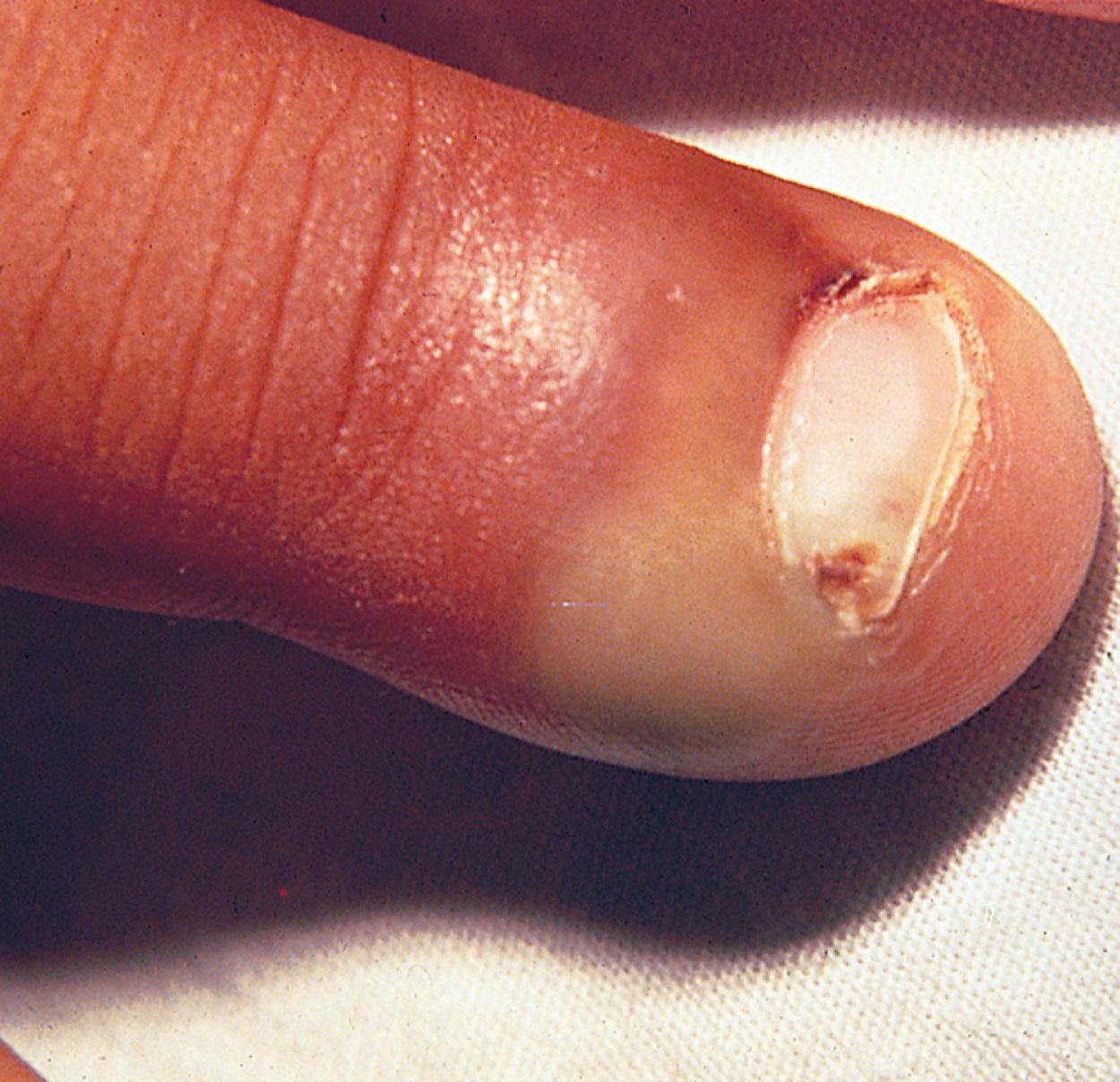 Fig. 13.26, Paronychia. Chewing on a hangnail predisposed this child to the development of a paronychia. Initially, erythema developed near the hangnail and was followed rapidly by suppuration.