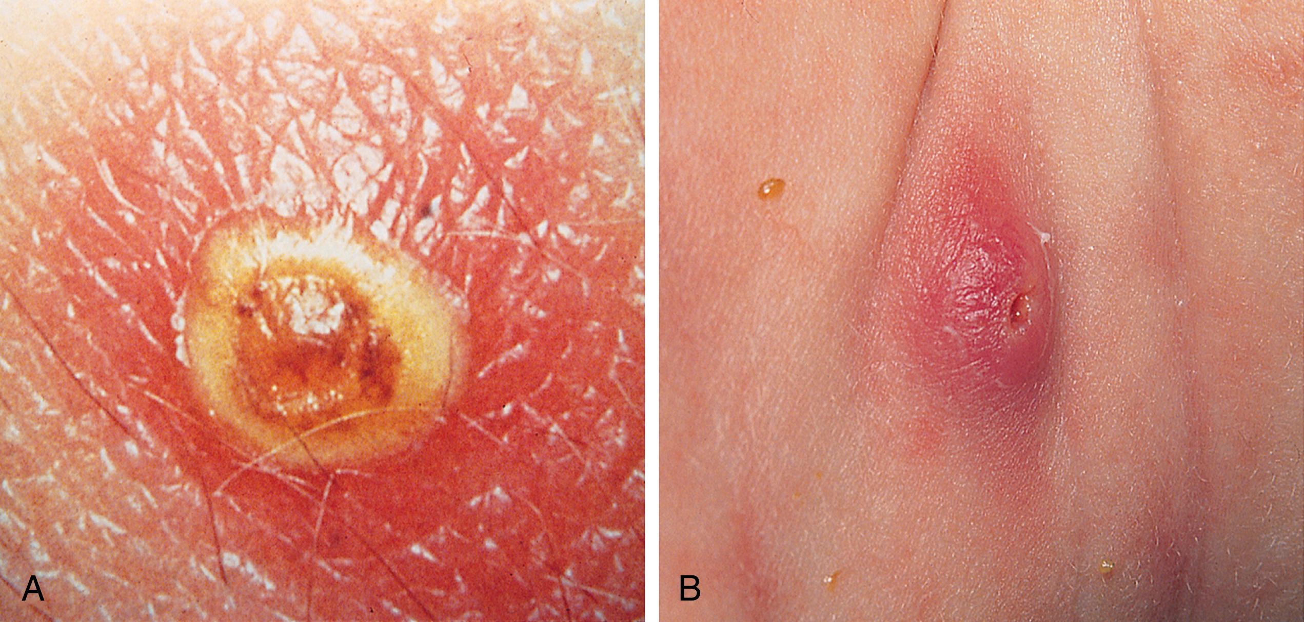 Fig. 13.27, Furuncle. (A) In this well-developed furuncle, the abscess has burrowed to the surface and the skin has thinned centrally and begun to necrose. A wide surrounding rim of erythema and induration exists. (B) This furuncle, located on the neck of a young infant, had spontaneously ruptured and drained earlier in the day but was beginning to enlarge again.