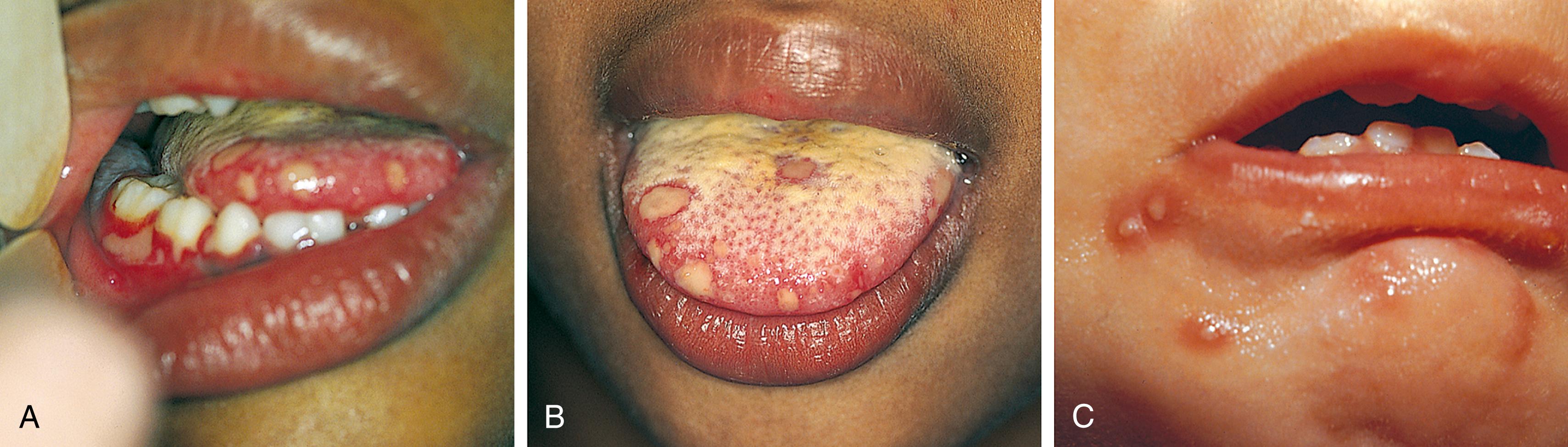 Fig. 13.3, Herpes simplex infections. (A) Herpetic gingivostomatitis is characterized by discrete mucosal ulcerations and diffuse gingival erythema, edema, and friability in association with fever, dysphagia, and cervical adenopathy. (B) Numerous yellow ulcerations with thin red halos are seen on the patient’s tongue as well. (C) Thick-walled vesicles on an erythematous base were noted in this child, who showed early findings of intraoral involvement.