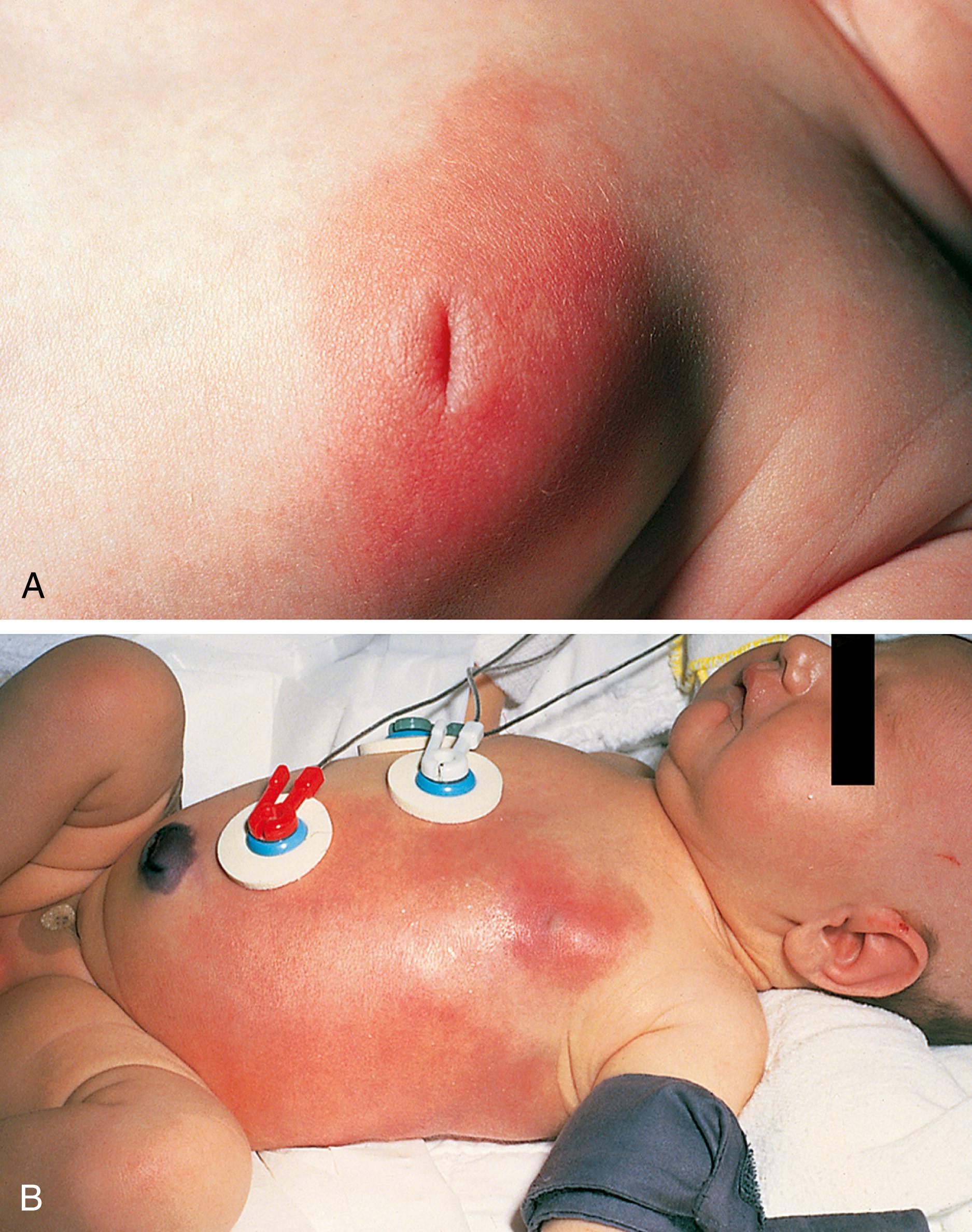 Fig. 13.29, Breast abscess. (A) The typical manifestations of a breast abscess were seen in this neonate—swelling, induration, tenderness, warmth, and erythema. With compression, pus could be expressed from the nipple. (B) This infant was not brought to the hospital until subcutaneous rupture and extensive cellulitic spread had occurred. She was febrile, toxic, irritable, and listless on presentation.