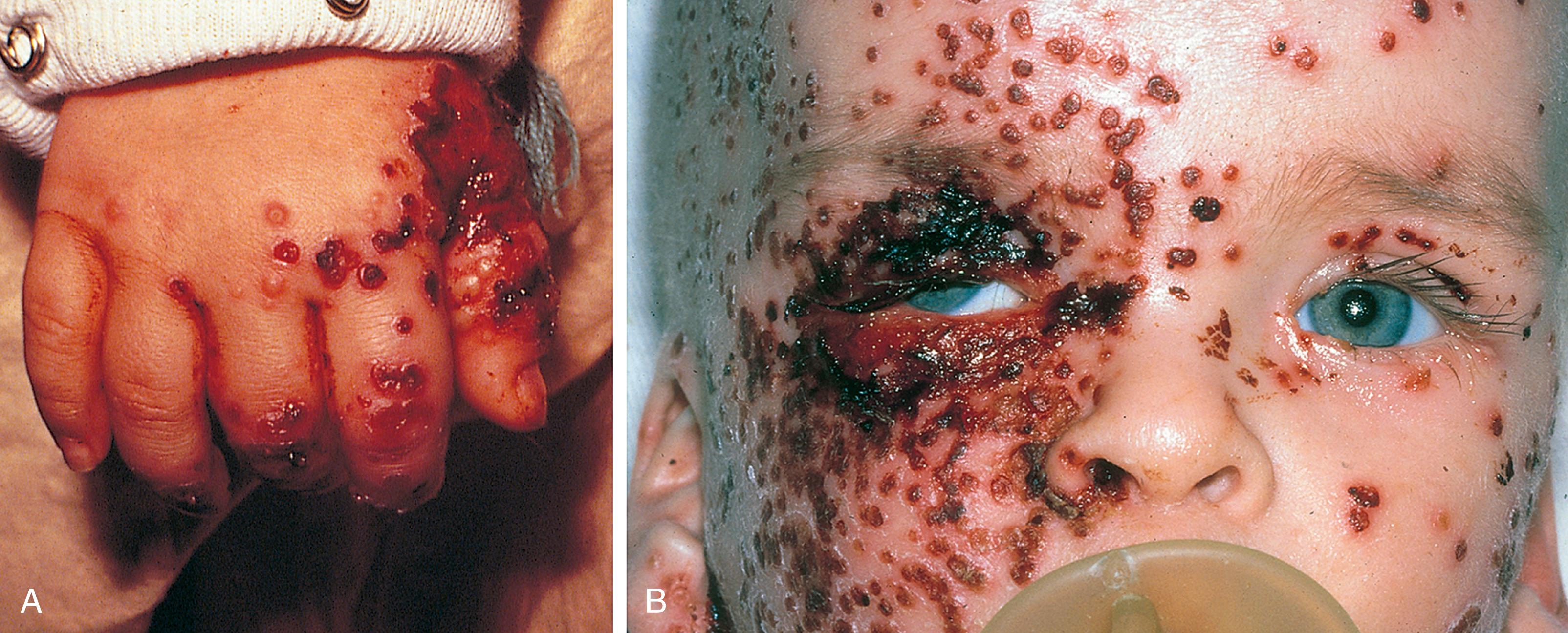 Fig. 13.6, Eczema herpeticum (Kaposi varicelliform eruption). Primary herpes simplex infection in a child with underlying eczema produces crops of hemorrhagic vesiculopustular lesions limited to areas of preexisting dermatitis, which then rupture and crust. Lesions are seen on the hand of one child (A) and on the face of another (B).