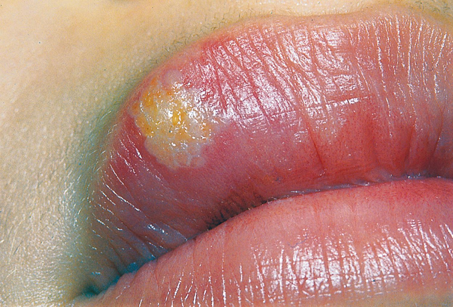 Fig. 13.7, Recurrent herpes labialis (cold sore). After a brief prodrome of burning, these grouped vesicles, filled with yellow fluid, erupted on the child’s upper lip.