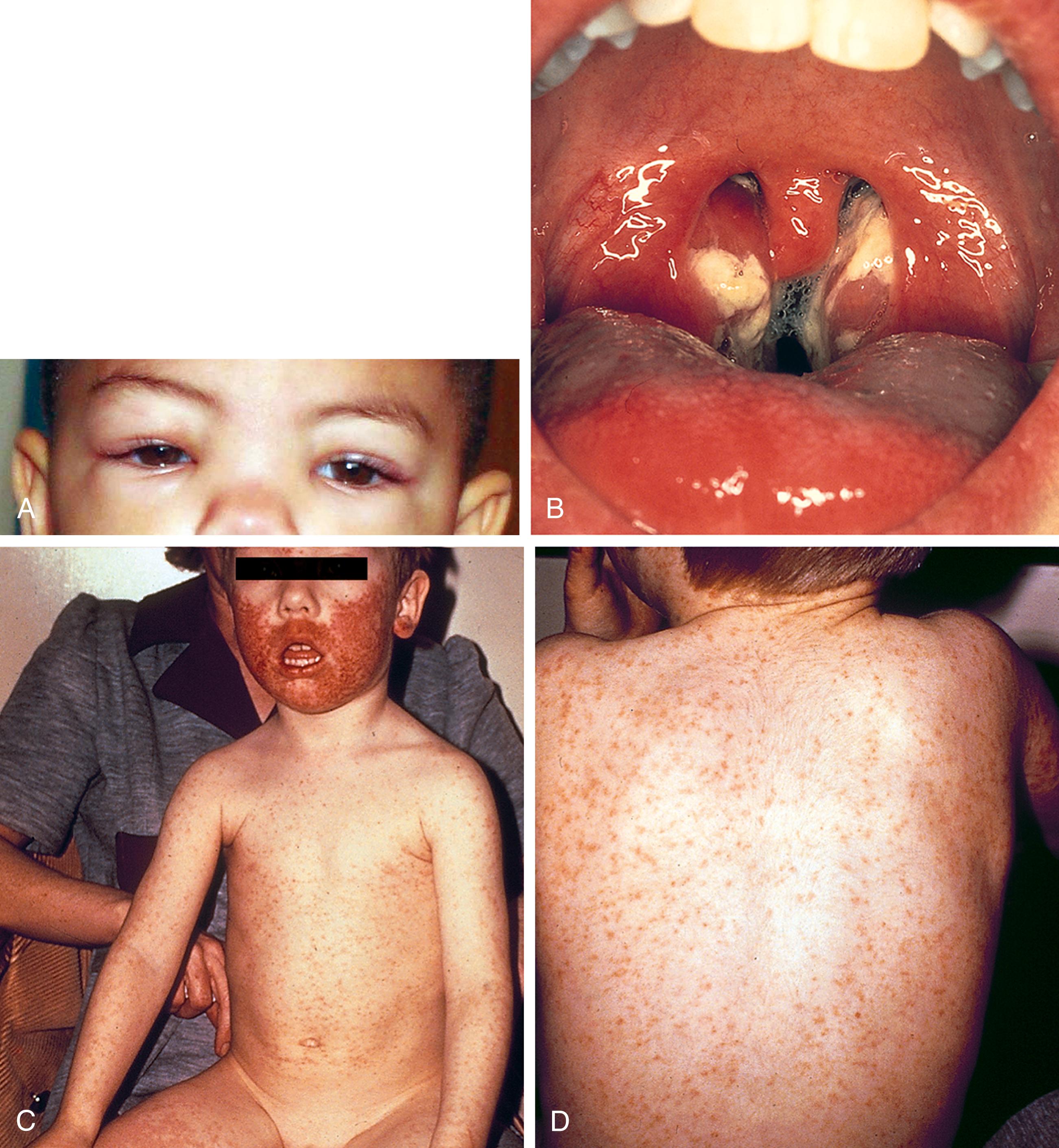 Fig. 13.8, Epstein-Barr virus (EBV) mononucleosis. (A) Eyelid edema is found in 50% of children with infectious mononucleosis. (B) Severe pharyngotonsillitis is seen in this child, whose tonsils are markedly enlarged and covered with exudate. The uvula is erythematous and edematous. (C and D) In this child with EBV mononucleosis, a diffuse, erythematous, maculopapular rash was part of the clinical picture. Lesions on his face are hemorrhagic and confluent as a result of prior irritation. (He had practiced shaving 2 days before.) Note also the swelling in the region of the tonsillar node and the fact that the child is mouth breathing as a result of adenoidal hypertrophy.