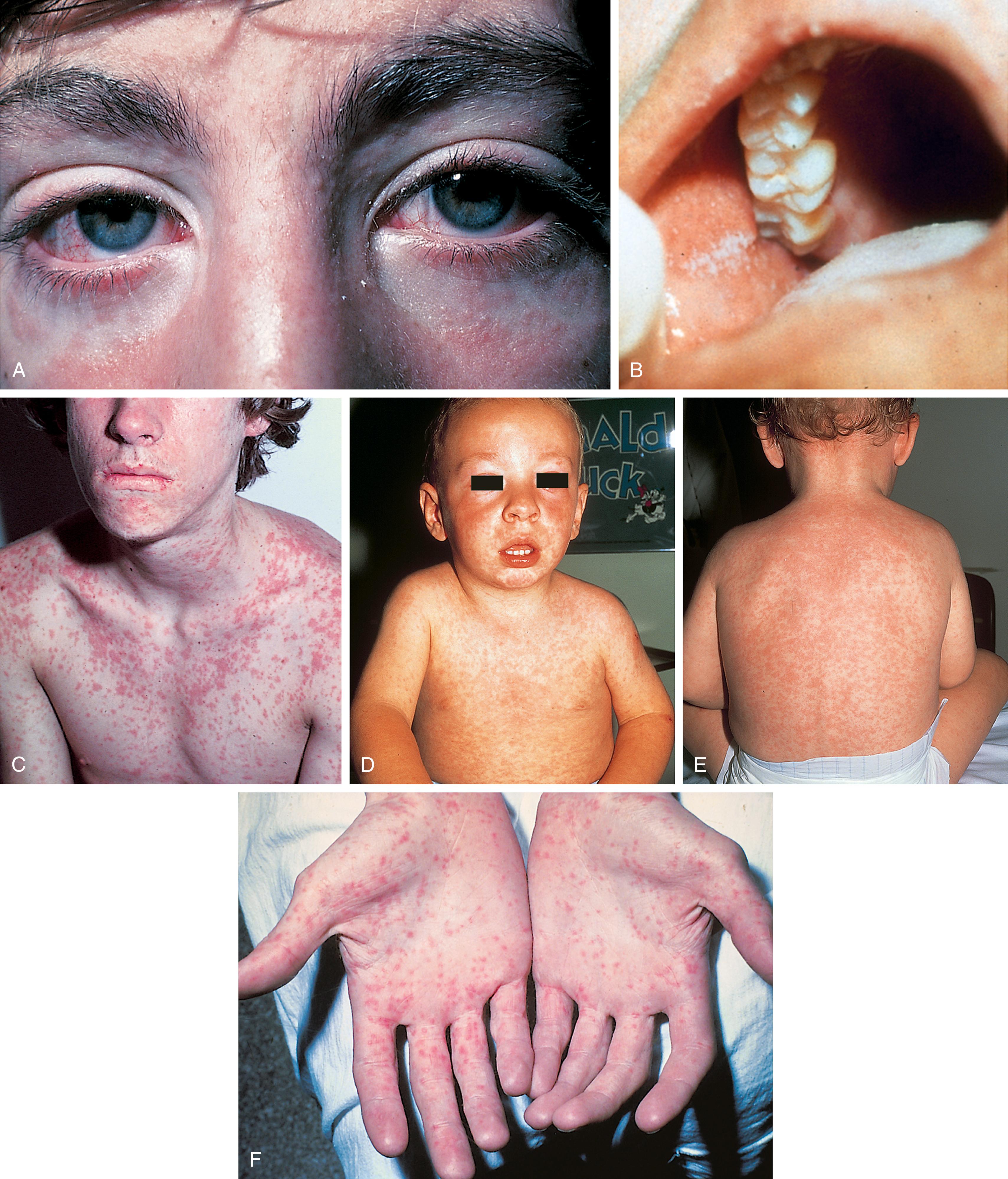 Fig. 13.9, Rubeola/measles. (A) During and after the prodromal period, the conjunctivae are injected and produce a clear discharge. This is associated with marked photophobia. (B) Koplik spots, bluish white dots surrounded by red halos, appear on the buccal and labial mucosa 1 or 2 days before the exanthem and begin to fade with onset of the rash. (C–E) The measles exanthem is a blotchy, erythematous, blanching maculopapular eruption that appears at the hairline and spreads cephalocaudally over 3 days, ultimately involving the palms and soles (F). With evolution, lesions become confluent at proximal sites.