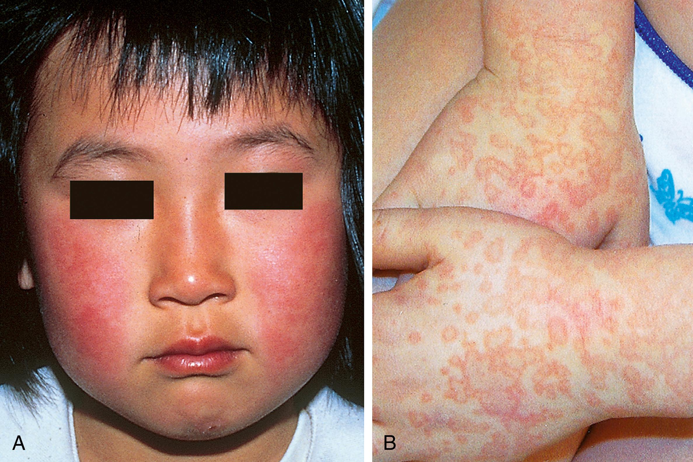 Fig. 13.10, Parvovirus, erythema infectiosum (fifth disease). (A) On day 1, warm, erythematous, nontender, circumscribed patches appear over the cheeks. (B) These fade on the next day, as an erythematous, lacy rash develops on the extensor surfaces of the extremities.