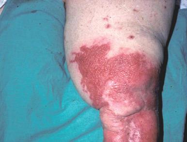 Fig. 17.2, Orthopedic cellulitis.