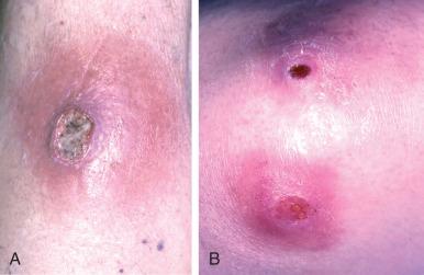 Fig. 17.4, (A and B) Examples of community-acquired methicillin-resistant Staphylococcus aureus (MRSA) infections of the skin. Lesions that have signs of necrosis, resemble spider bites, or have pain and erythema out of proportion to visual inspection are highly suggestive of community-acquired MRSA.