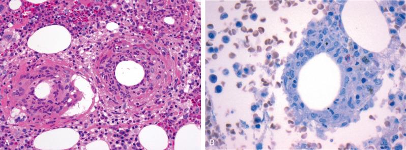 Figure 13.4, Fibrin ring granulomas in a bone marrow biopsy, characterized by a central empty space surrounded by histiocytes and neutrophils that may or may not be encircled by a concentric ring of fibrin ( A, hematoxylin and eosin stain; B, Giemsa stain).