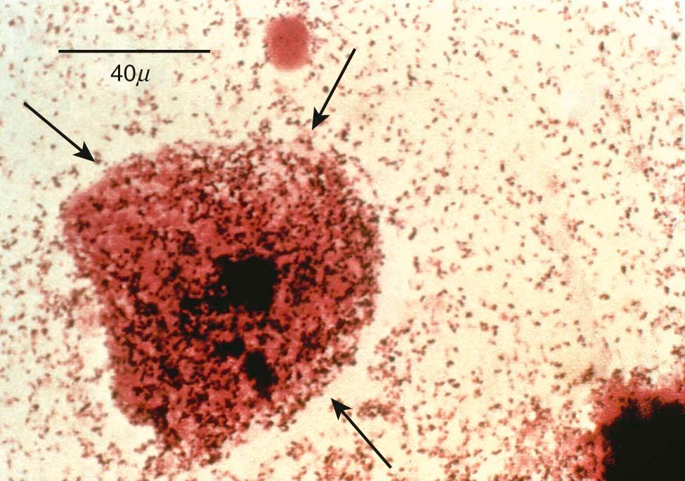 FIGURE 22-1, Wet mount microscopy of vaginal secretions from a patient with bacterial vaginosis. Note the presence of a clue cell, which is an epithelial cell with “serrated” edges caused by bacteria (arrows) .