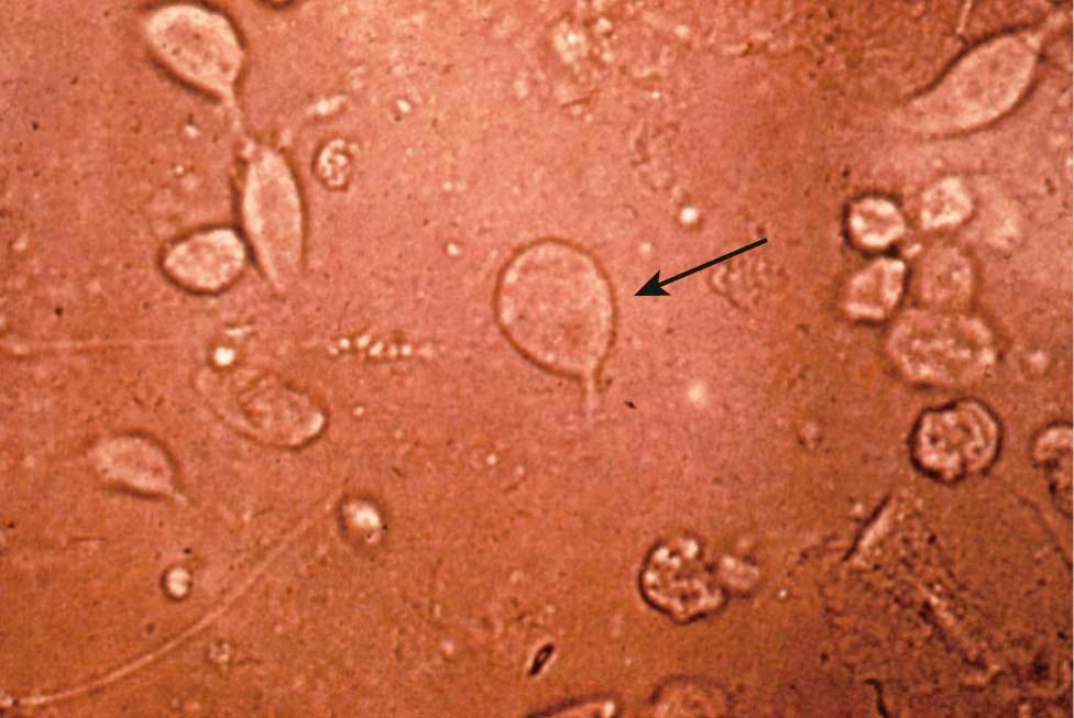 FIGURE 22-2, Microscopic view (high power) of a trichomonad (arrow) in a saline wet-mount preparation. The organisms are usually motile in this type of preparation.