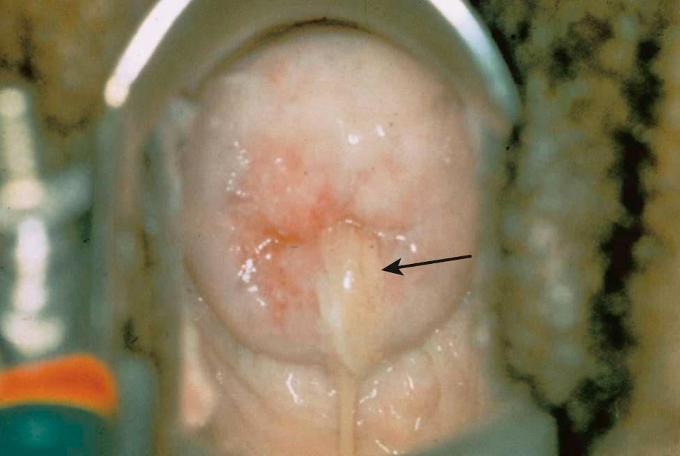 FIGURE 22-4, Uterine cervix at the time of speculum examination with yellow mucopus protruding from the os (arrow) .