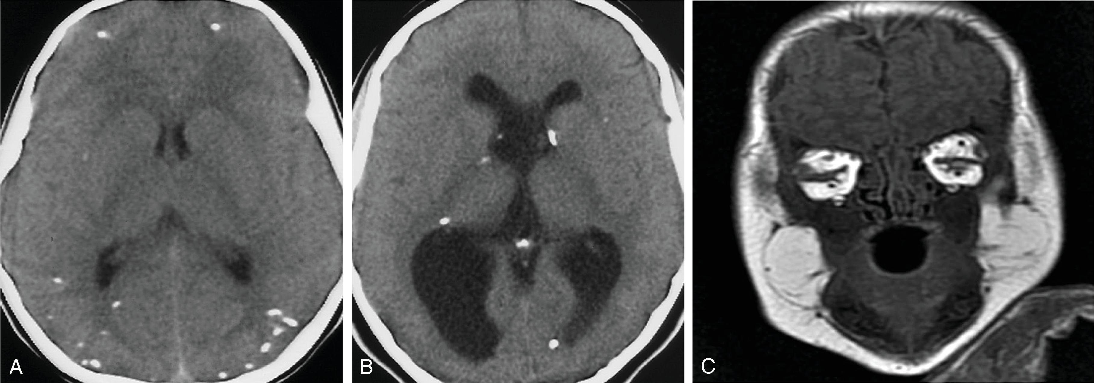 Fig. 5.10, Congenital Toxoplasmosis .