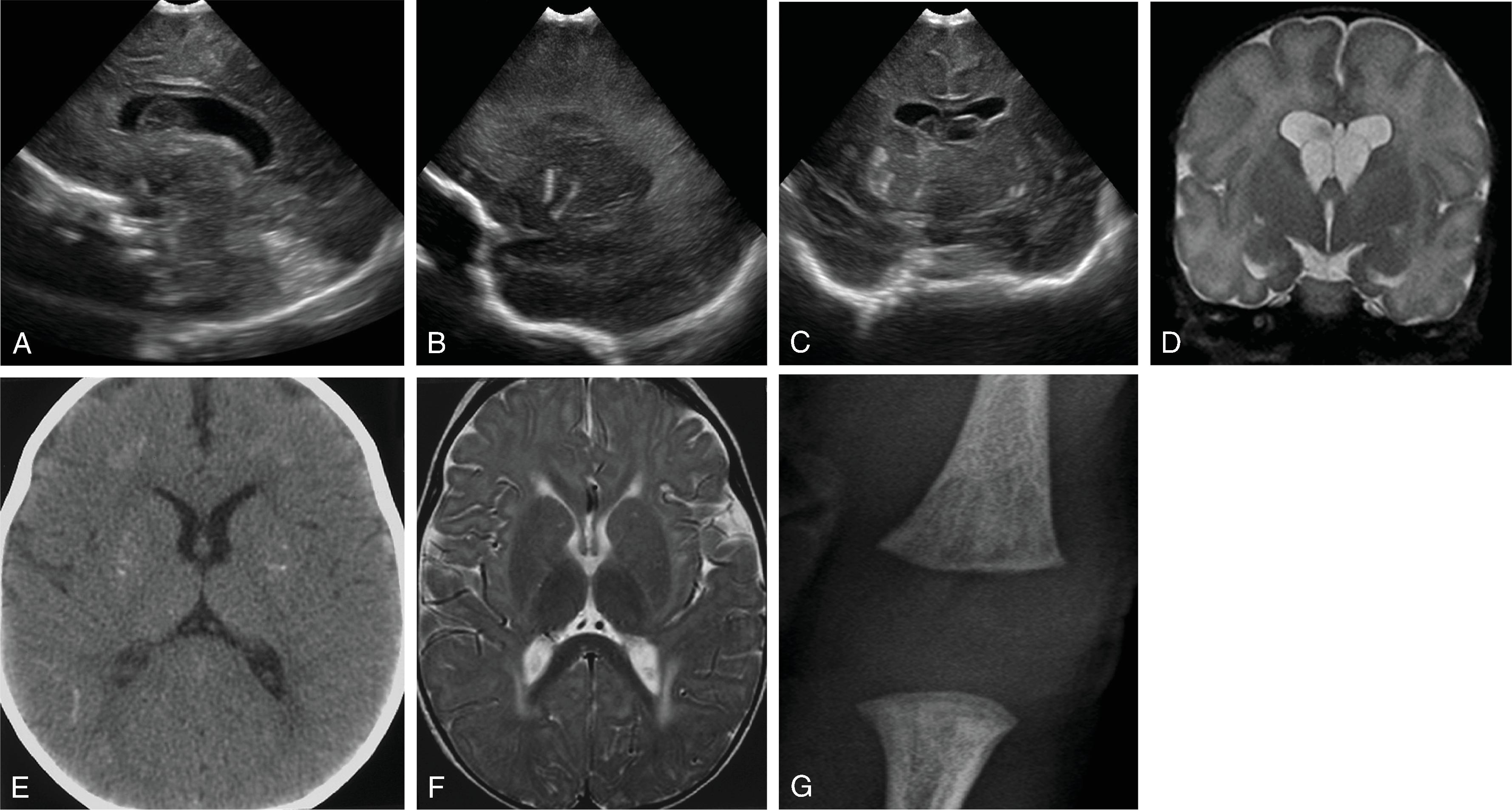 Fig. 5.11, Congenital Rubella .