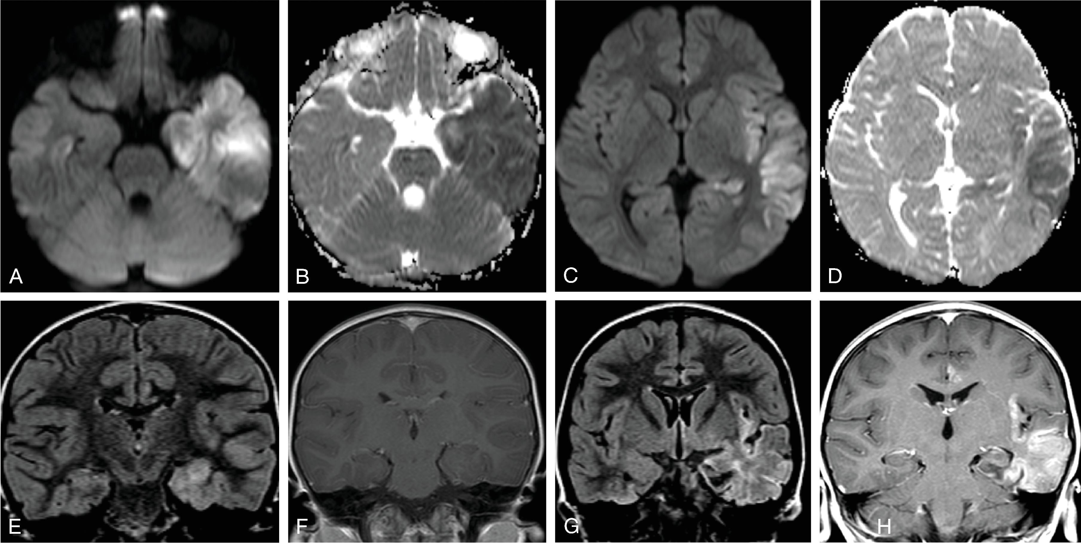 Fig. 5.14, Herpes Encephalitis (HSV-1): 3-year-old with fever and seizure .