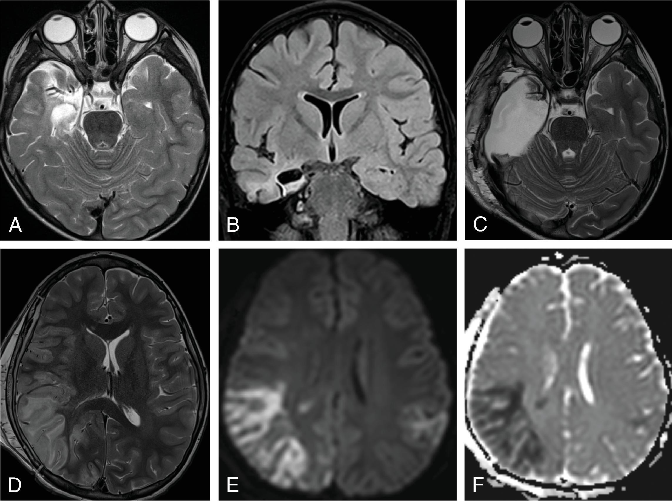 Fig. 5.15, Herpes Encephalitis (HSV-1): 4-year-old with rare HSV-1 reactivation .