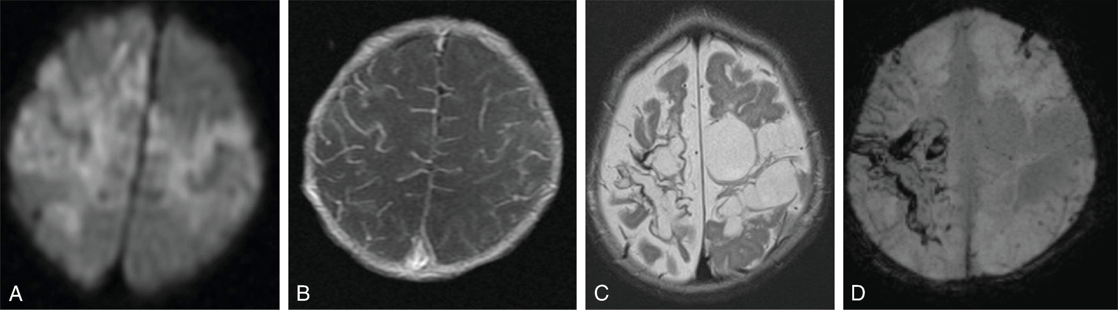 Fig. 5.16, Herpes Encephalitis (HSV-2) .