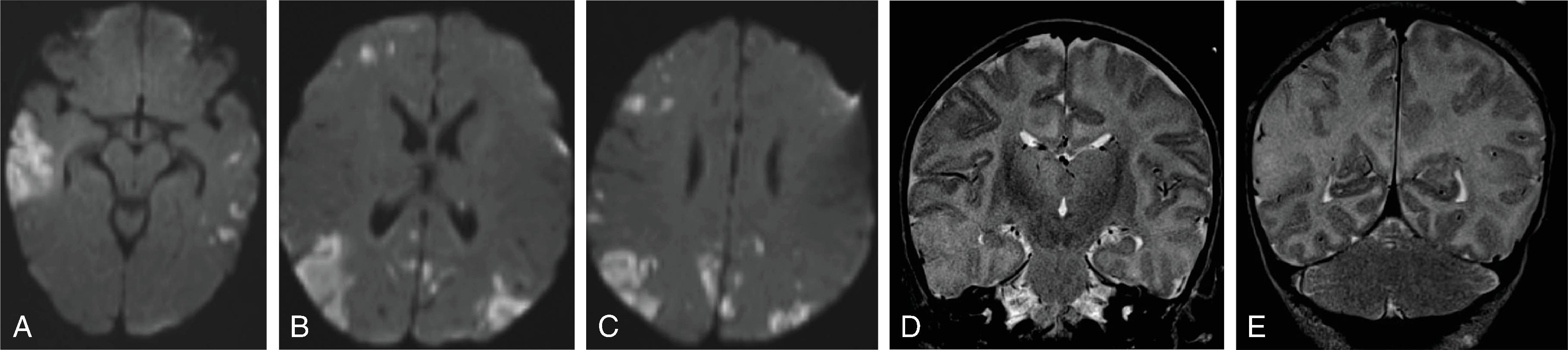 Fig. 5.17, Herpes Encephalitis (HSV-2) .