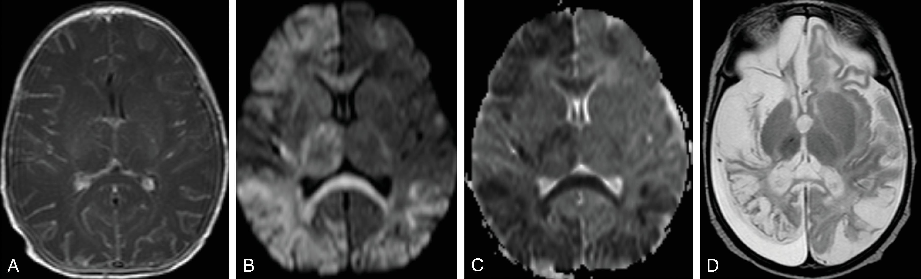 Fig. 5.18, Herpes Encephalitis (HSV-2): 16-day-old with seizures and congestion .