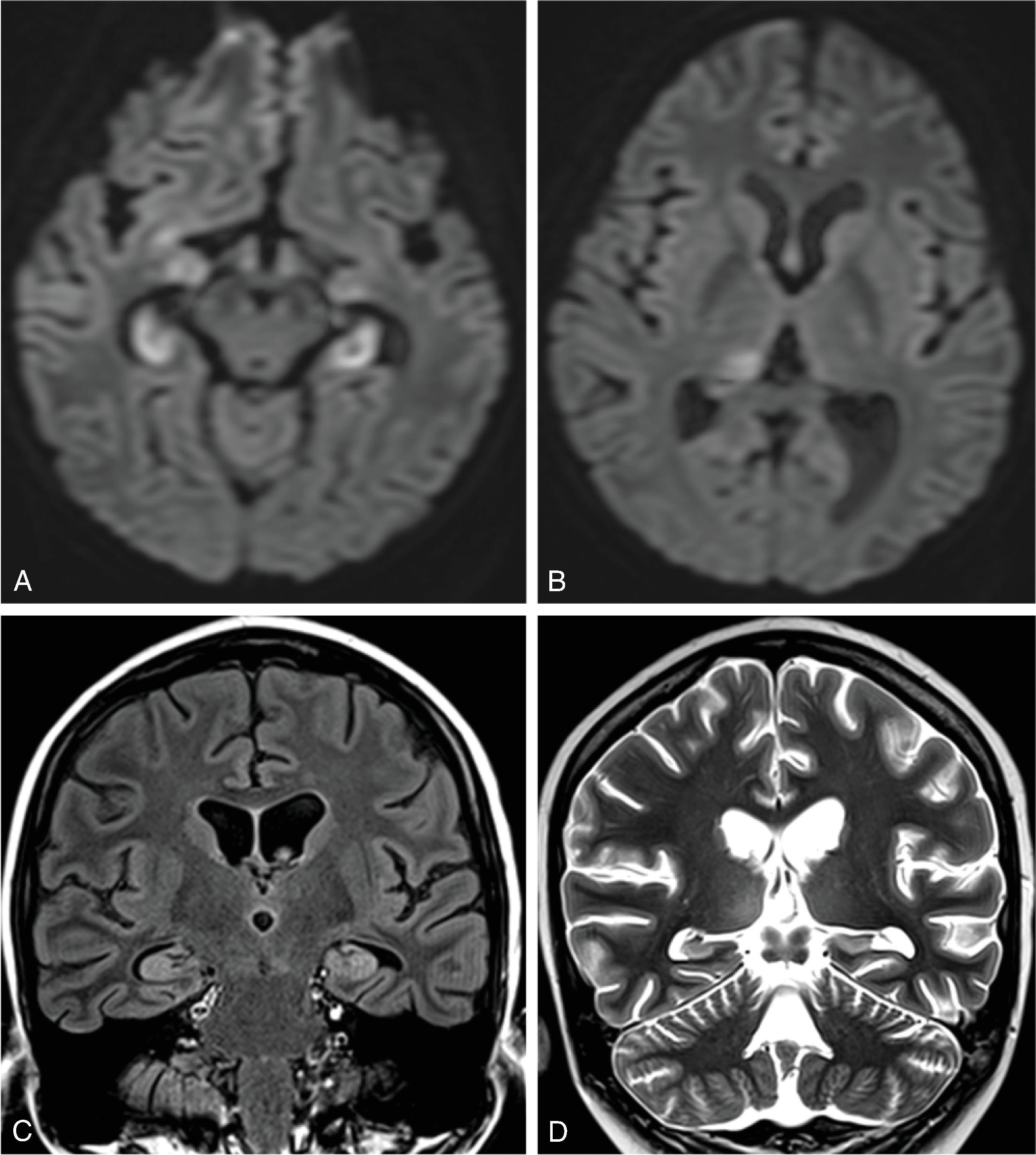 Fig. 5.19, Human Herpesvirus 6 Encephalitis .