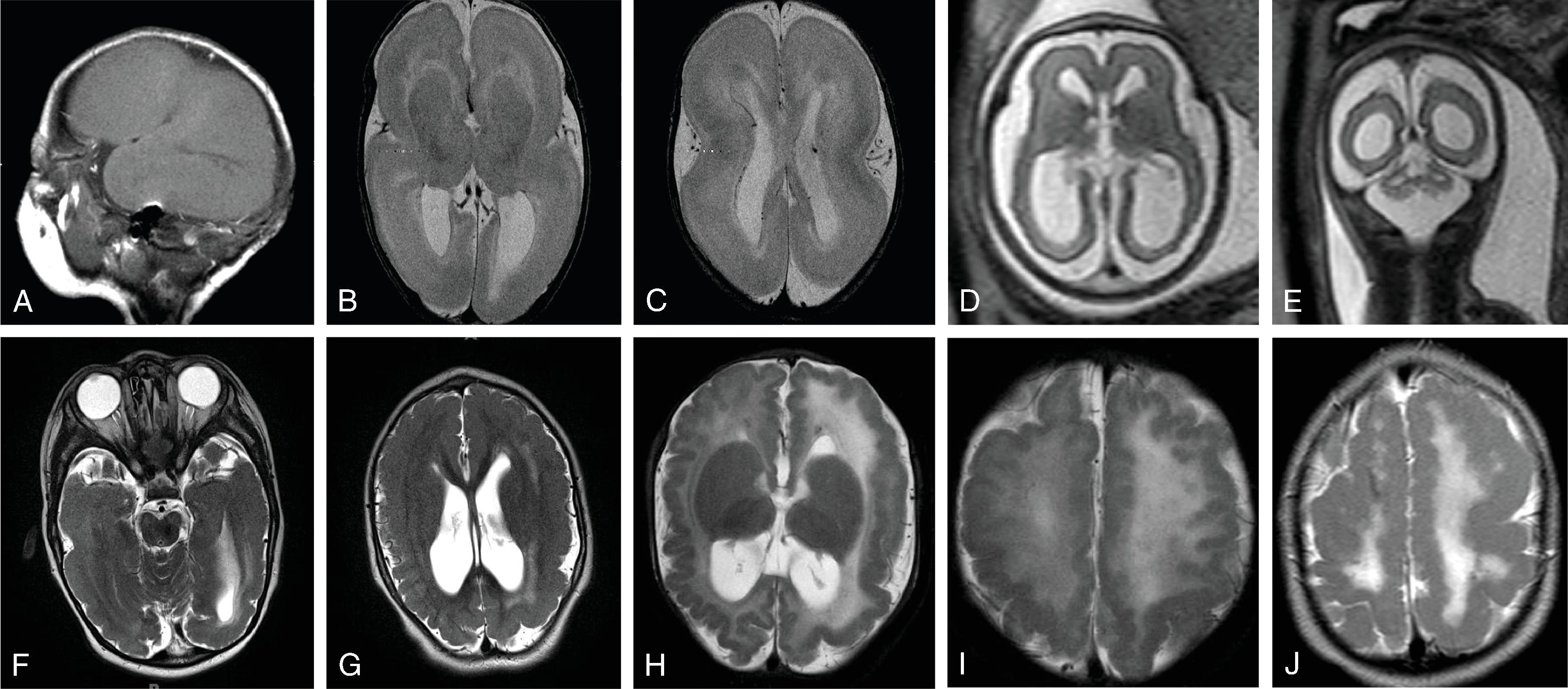 Fig. 5.1, Congenital Cytomegalovirus (CMV): Cortical Malformations .