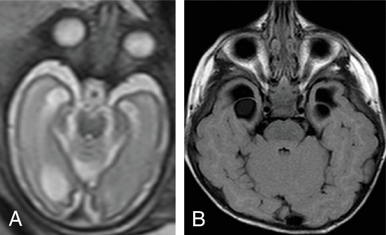 Fig. 5.3, Congenital Cytomegalovirus (CMV): Temporal Cyst .