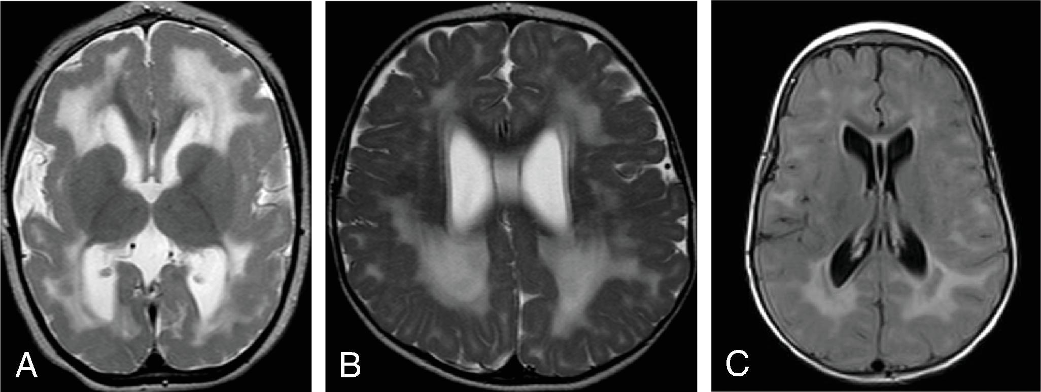 Fig. 5.4, Congenital Cytomegalovirus (CMV): Leukodystrophy .