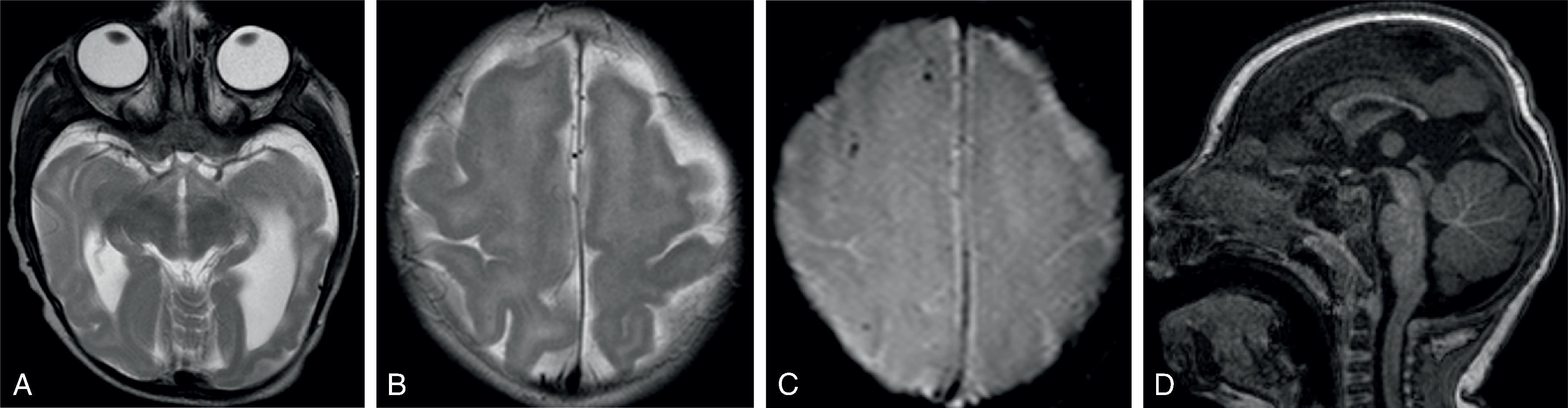 Fig. 5.5, Congenital Zika: 9–month-old with severe microcephaly .