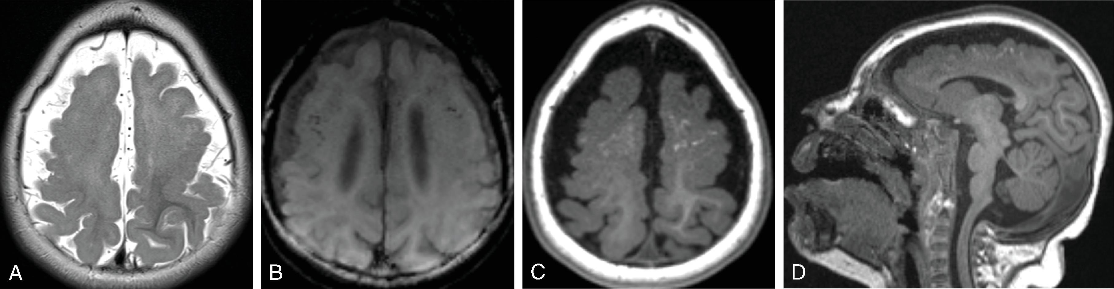 Fig. 5.6, Congenital Zika: 10-month-old with severe microcephaly .