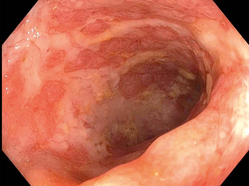 FIGURE 4.1, Cytomegalovirus produces confluent serpentine ulcers in the distal colon of an immunocompromised patient.