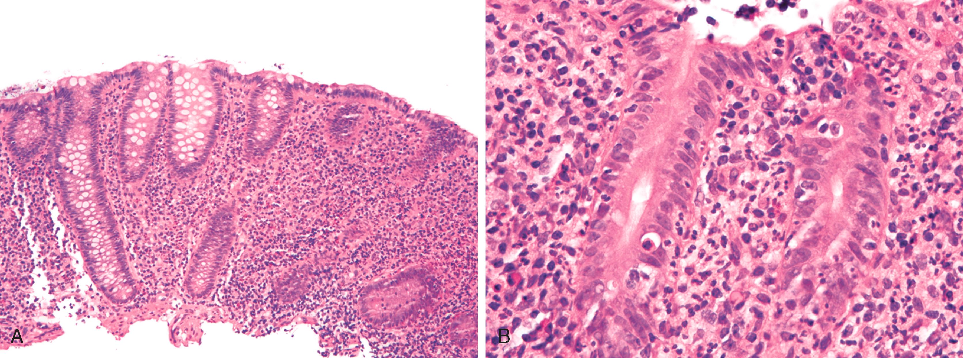 FIGURE 4.11, A, Acute self-limited colitis features increased lamina propria inflammation with preserved architecture. B, Neutrophil-rich inflammation is present in the lamina propria and infiltrating damaged crypts.