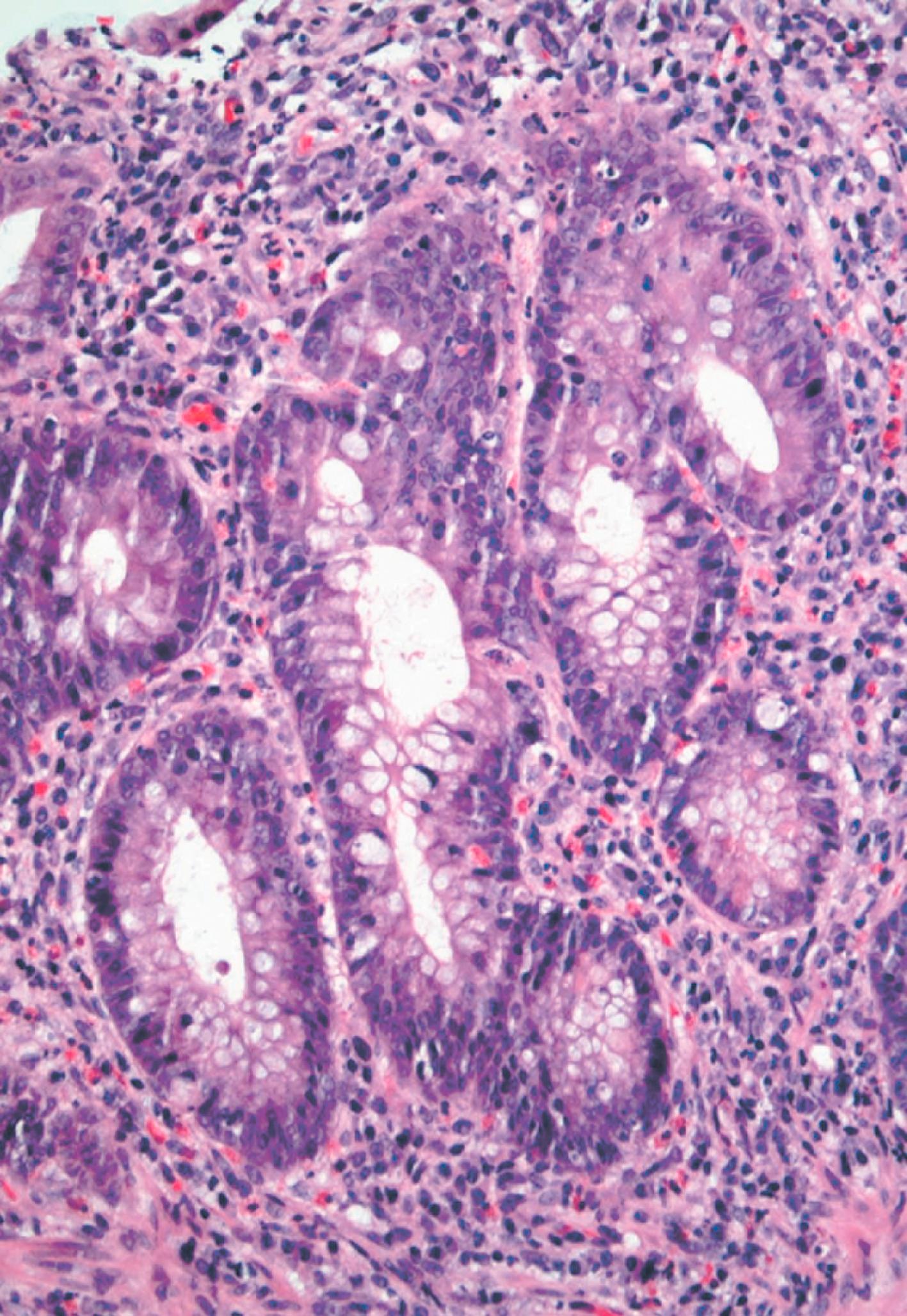 FIGURE 4.12, Focal cryptitis and architectural distortion are seen in a right colon biopsy specimen in a case of culture-proven Aeromonas infection that was initially thought to be Crohn’s disease based on the endoscopic appearance.