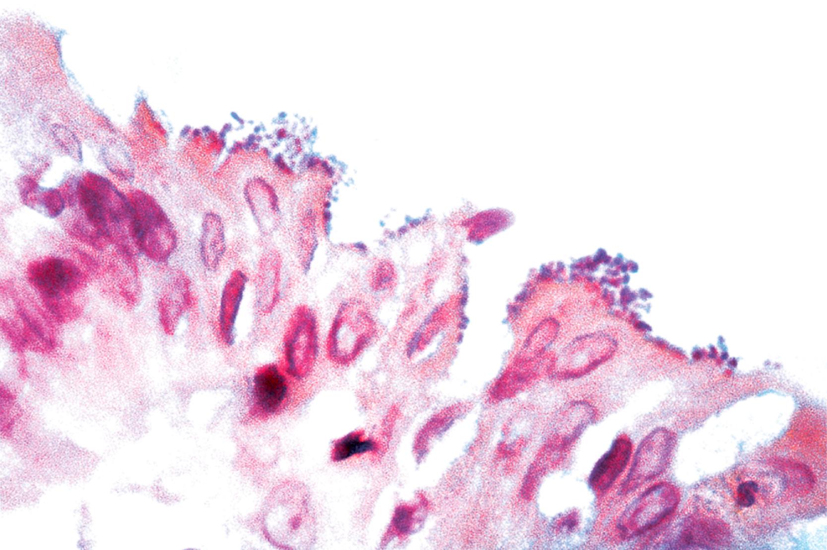 FIGURE 4.13, Enteroadherent Escherichia coli in a patient with AIDS. A coating of gram-negative rods with little inflammatory reaction is seen at the surface of the colonic mucosa (Gram stain).