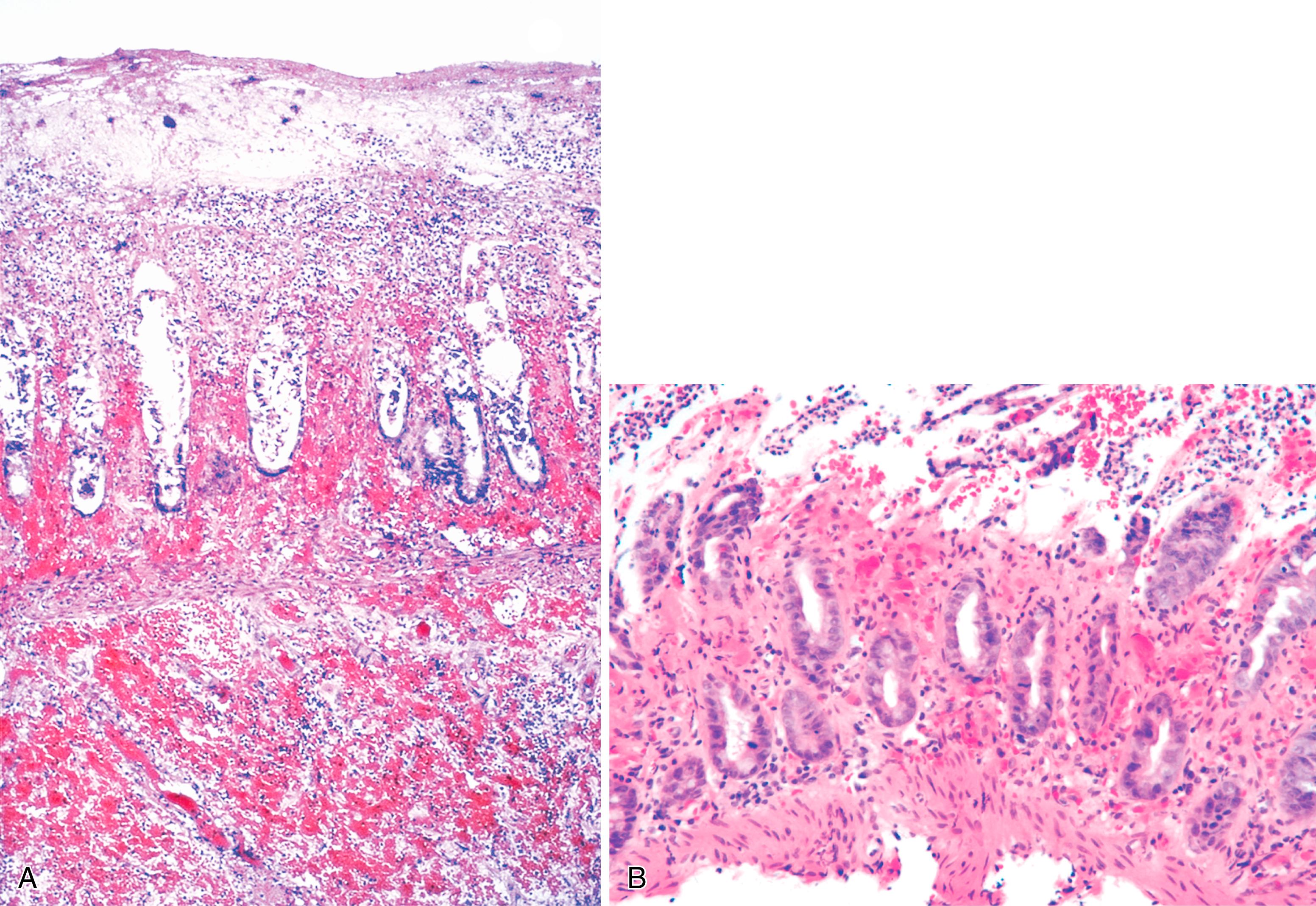 FIGURE 4.14, Enterohemorrhagic Escherichia coli . A, Transmural hemorrhagic necrosis and an acute inflammatory exudate are seen in this right colon resection from a patient with E. coli O157:H7 infection. B, The crypt withering and lamina propria hyalinization simulate ischemic colitis.