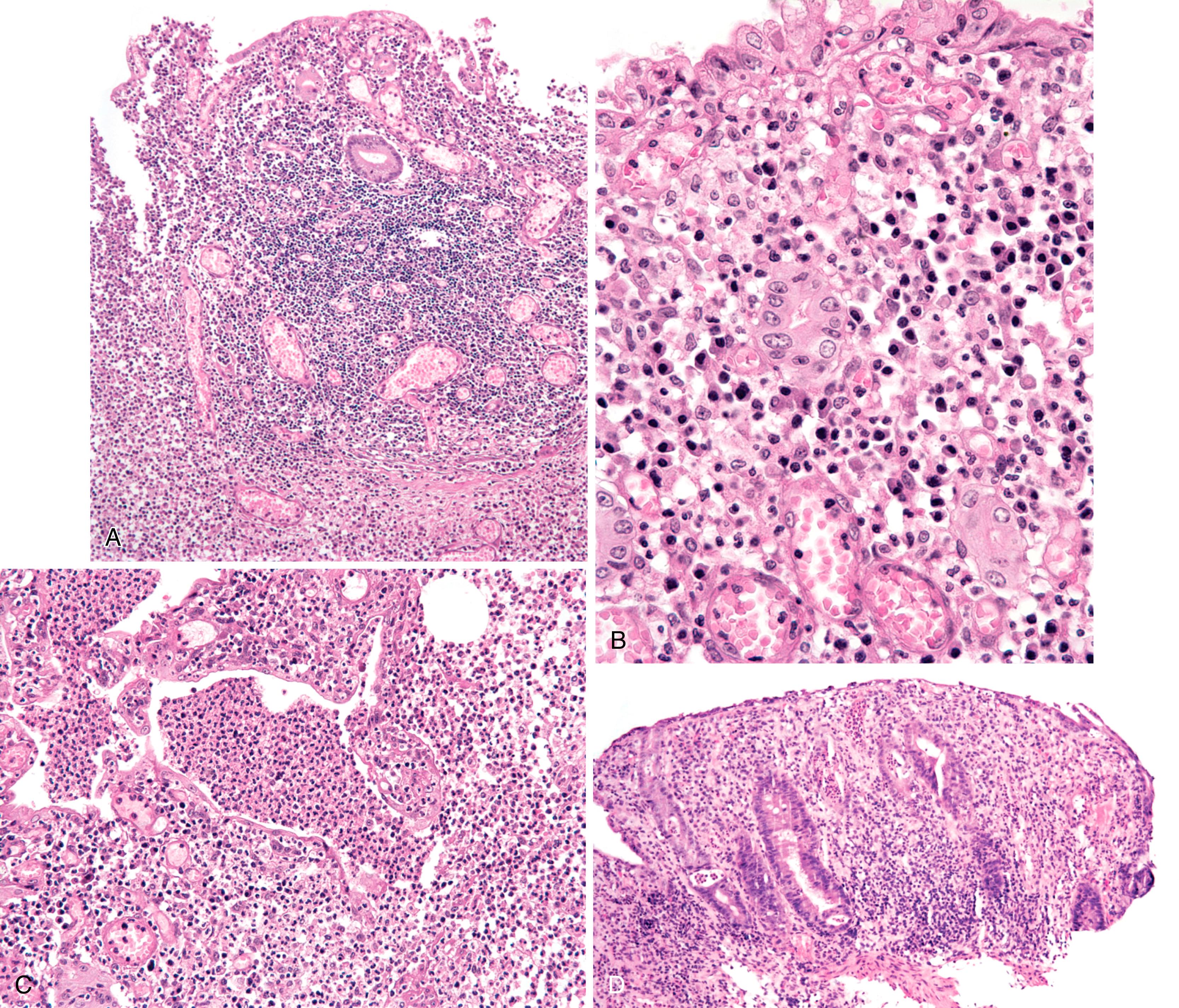 FIGURE 4.15, A, The typical histological lesion of typhoid fever is ulceration overlying a lymphoid aggregate or Peyer’s patch. B, The typical inflammatory infiltrate is predominantly mononuclear, featuring plasma cells, lymphocytes, and histiocytes, with inconspicuous neutrophils. C, Architectural distortion can mimic that of chronic idiopathic inflammatory bowel disease. D, Nontyphoid Salmonella infection often shows features of acute infectious-type colitis but can also exhibit mild architectural disarray and gland loss.