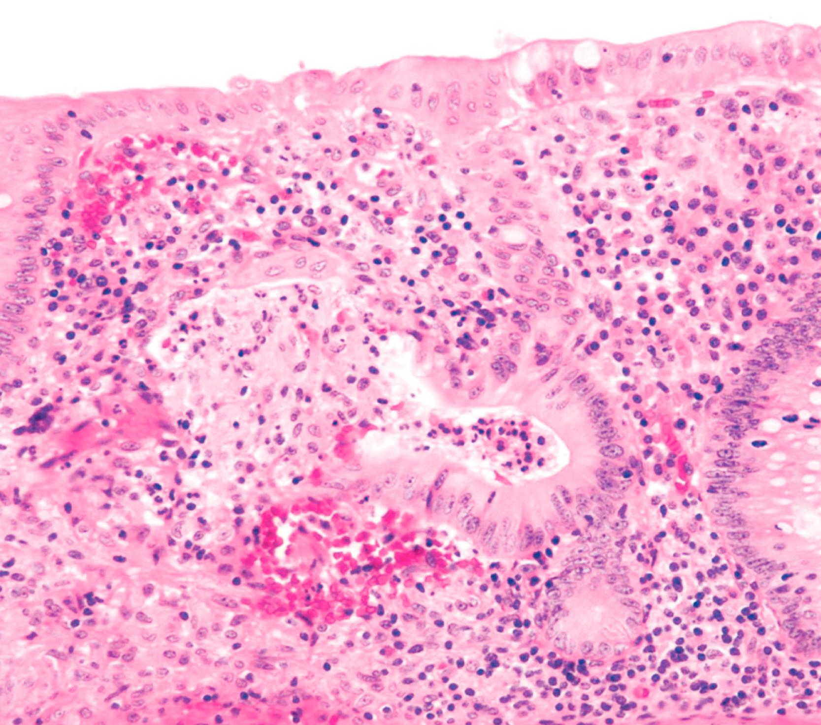 FIGURE 4.16, This biopsy from a patient with Shigella sonnei infection shows cryptitis, a crypt abscess, and a mucin granuloma centered on a damaged gland.