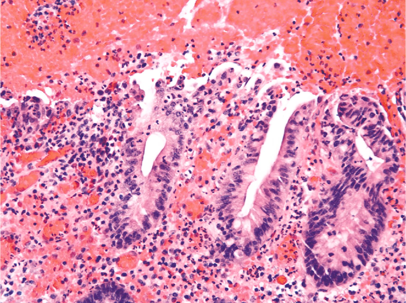 FIGURE 4.17, This case of culture-proven Campylobacter jejuni colitis shows a neutrophilic infiltrate with overlying surface mucosal erosion and hemorrhage. The architecture is largely preserved.