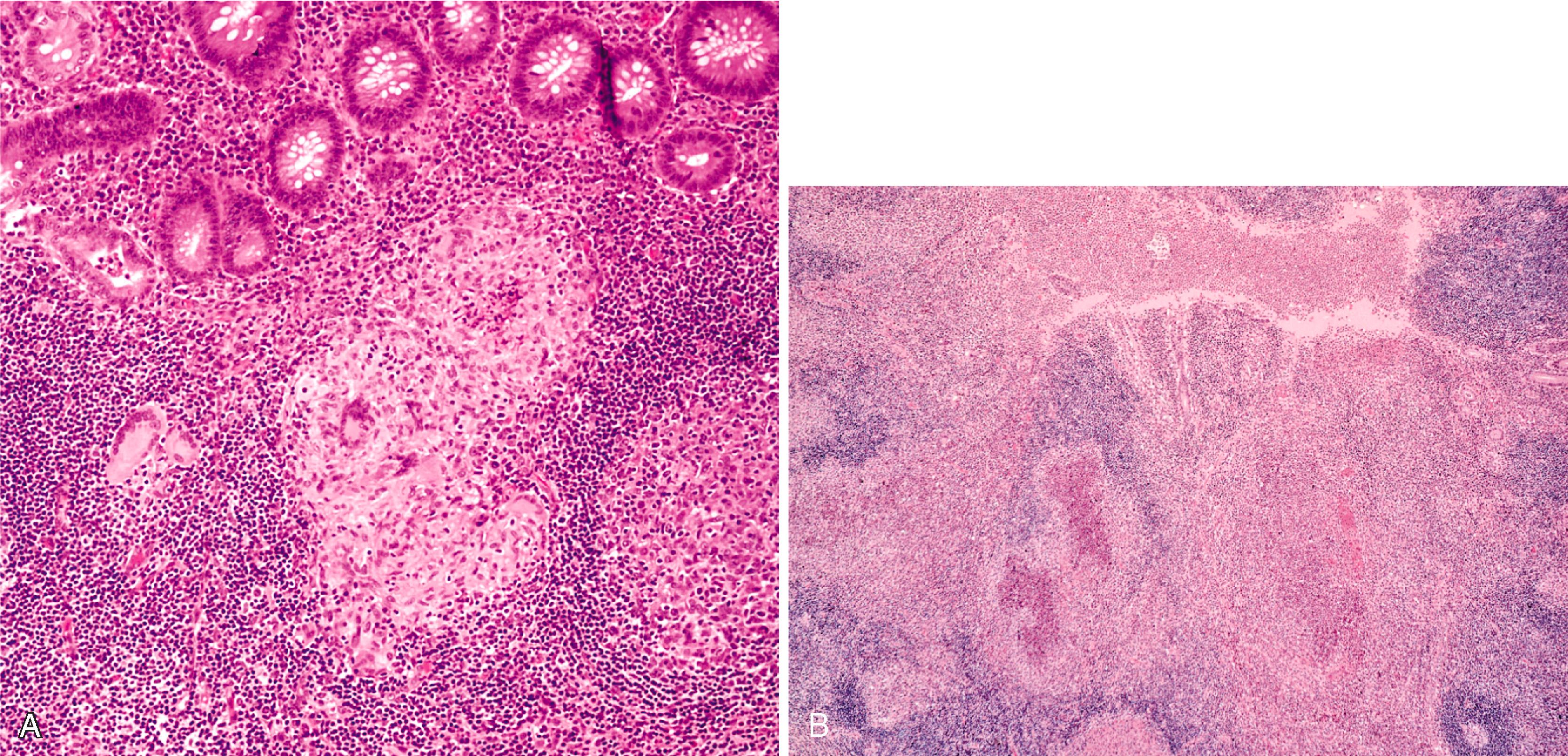 FIGURE 4.18, A, Epithelioid granulomas with prominent lymphoid cuffs are typical of Yersinia enterocolitica infection. B, Lymphoid hyperplasia with necrotizing granulomatous inflammation and prominent microabscess formation in a case of appendicitis caused by Yersinia pseudotuberculosis .