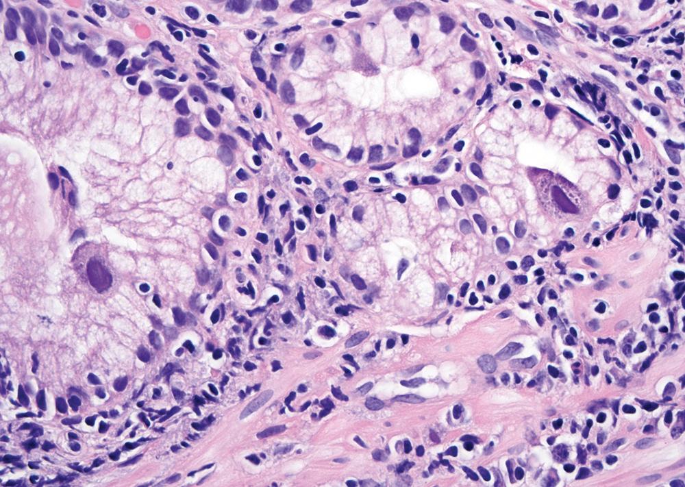 FIGURE 4.3, CMV may infect epithelial cells in the upper gastrointestinal tract. Nuclear and cytoplasmic inclusions are present in Brunner’s glands in this duodenal biopsy.