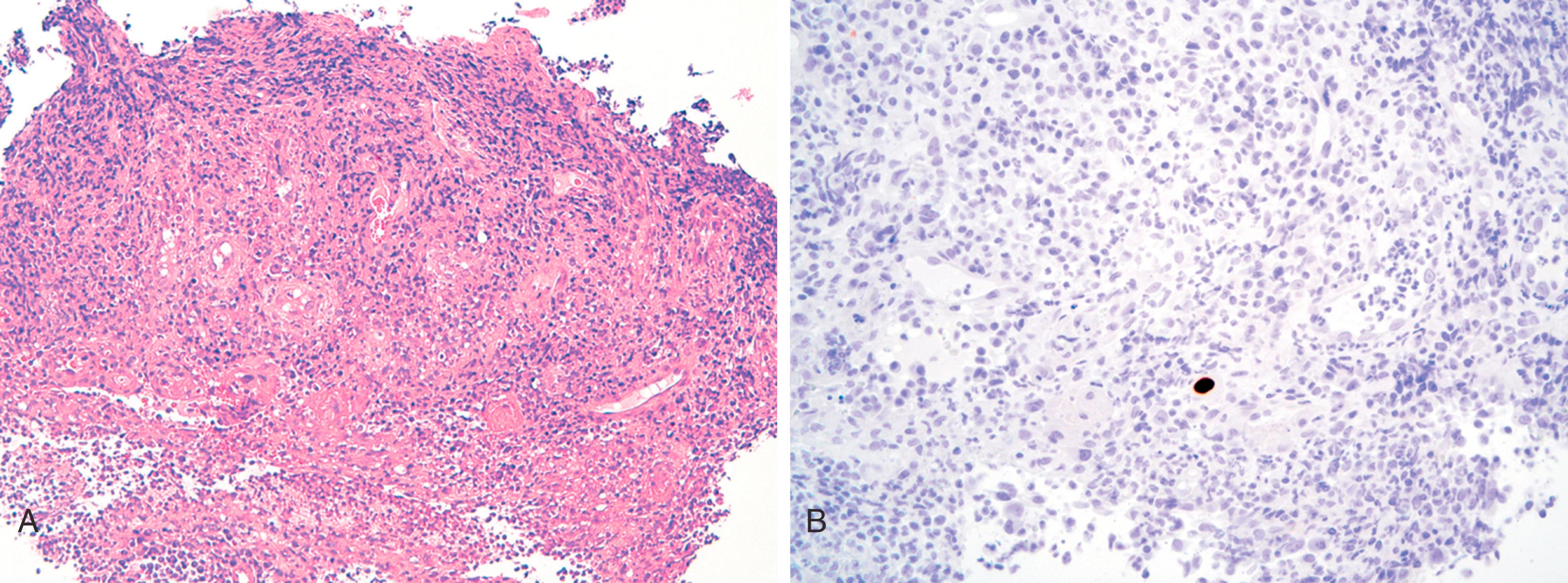 FIGURE 4.4, A, Cytomegalovirus inclusions are easily missed in inflamed granulation tissue. B, An immunostain highlights rare inclusions.