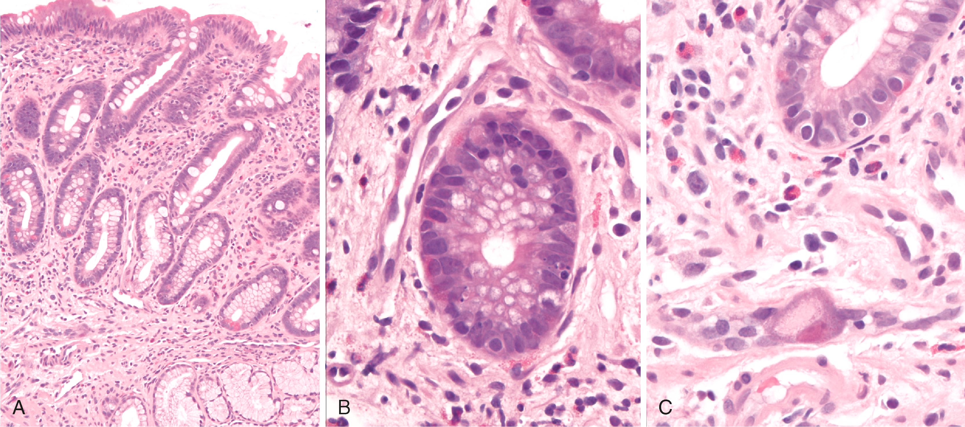 FIGURE 4.5, A, Biopsy samples from the duodenum of a patient with graft-versus-host disease do not show increased inflammation. B, Numerous apoptotic bodies are present, but are small and inconspicuous, as is typical in the upper gastrointestinal tract. C, A single cytomegalovirus inclusion is present in an endothelial cell, but is unassociated with an inflammatory reaction.