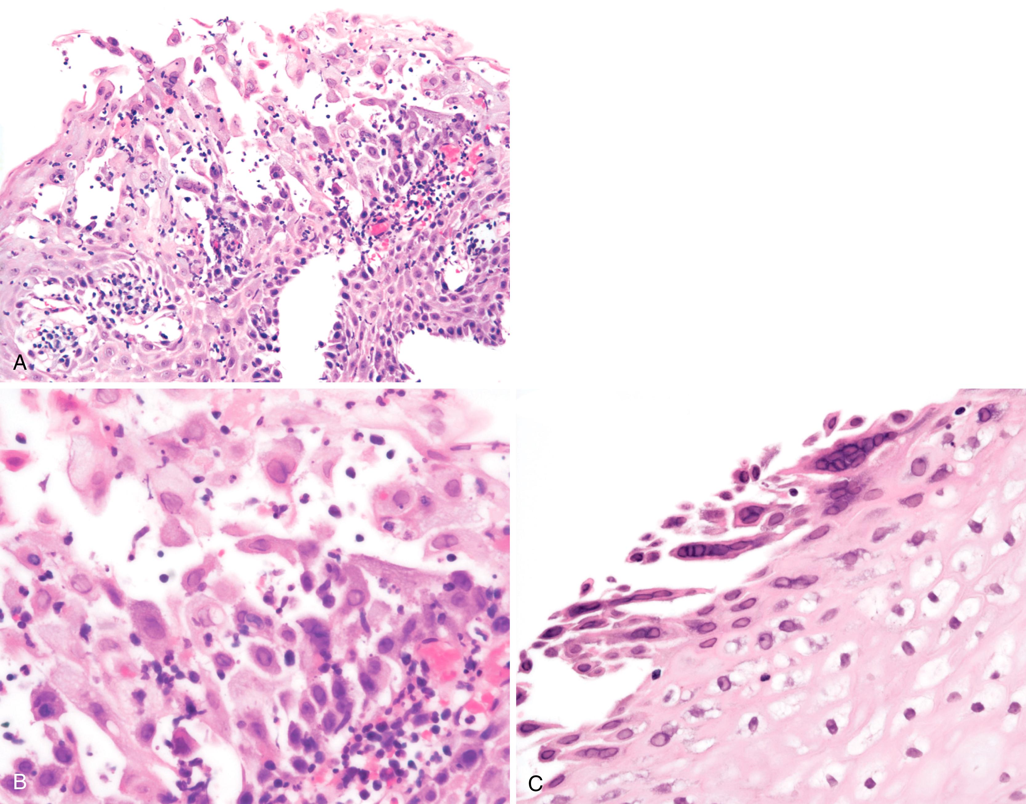 FIGURE 4.6, A, Esophageal biopsy shows dyshesion and sloughing of squamous epithelial cells, intraepithelial neutrophils, and herpetic inclusions within squamous cells. B, Higher-power view shows the homogeneous basophilic “ground-glass” inclusions of herpes simplex virus with peripherally marginated chromatin. C, Multiple inclusions may be present within a single cell, known as a polykaryon.