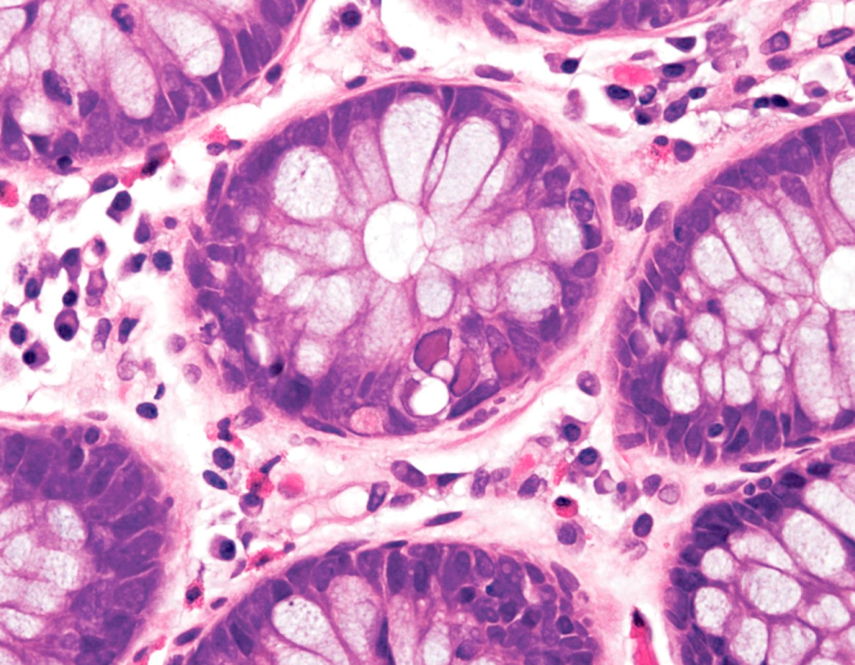 FIGURE 4.7, Multiple adenovirus inclusions, or “smudge cells,” are seen within the colonic epithelial cells in this biopsy from a patient with AIDS.