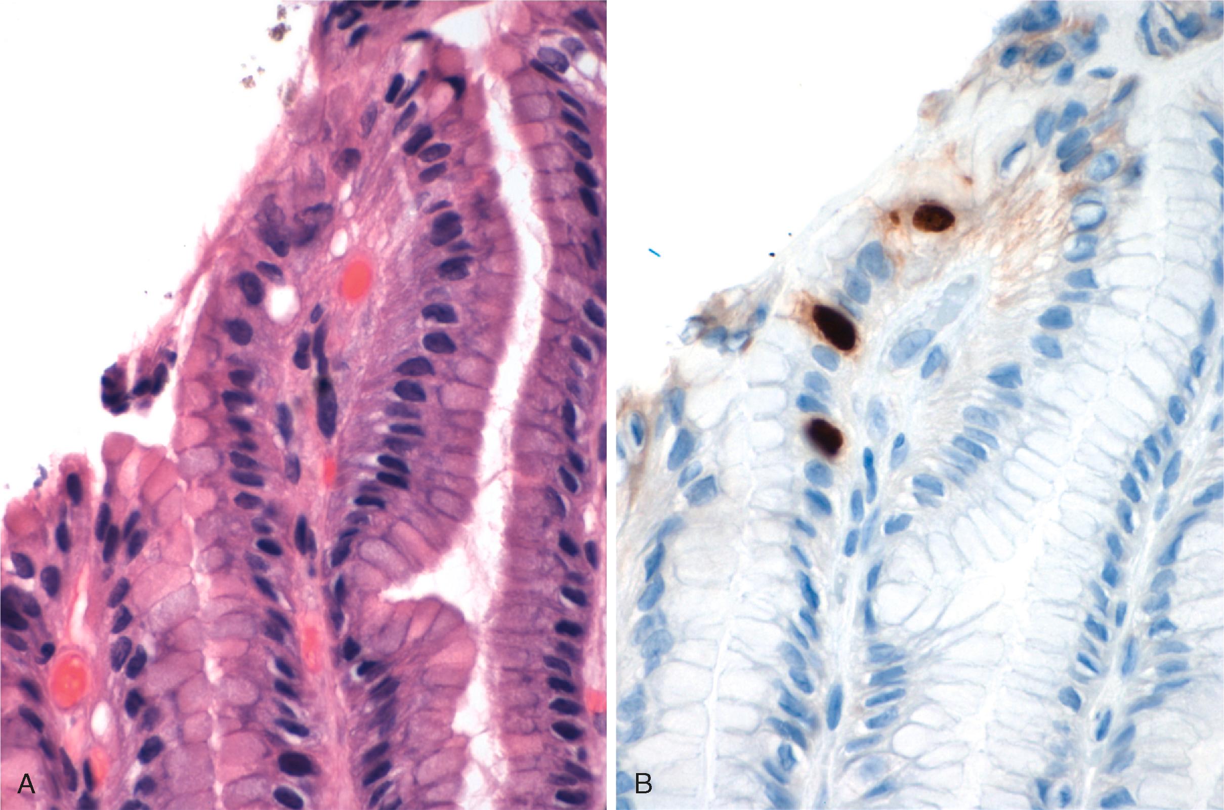 FIGURE 4.8, A, Adenovirus inclusions are barely perceptible in the foveolar epithelial cells of this gastric biopsy. B, Immunohistochemical stains are necessary to make the diagnosis.