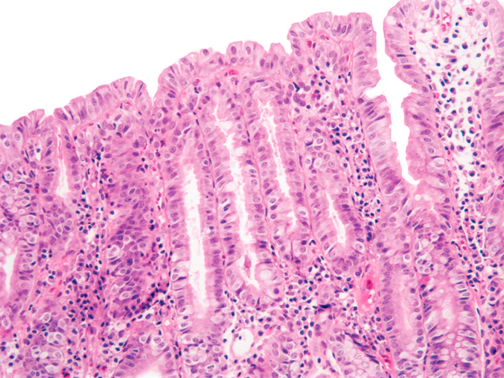 FIGURE 4.9, Villous fusion, surface reactive and degenerative changes, and mononuclear cell infiltrates are nonspecific features that can be seen in biopsies from patients with gastroenteritis caused by enteric viruses.
