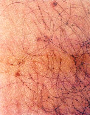 Fig. 4.1, Pediculosis pubis (crab lice) attached to hair shafts.